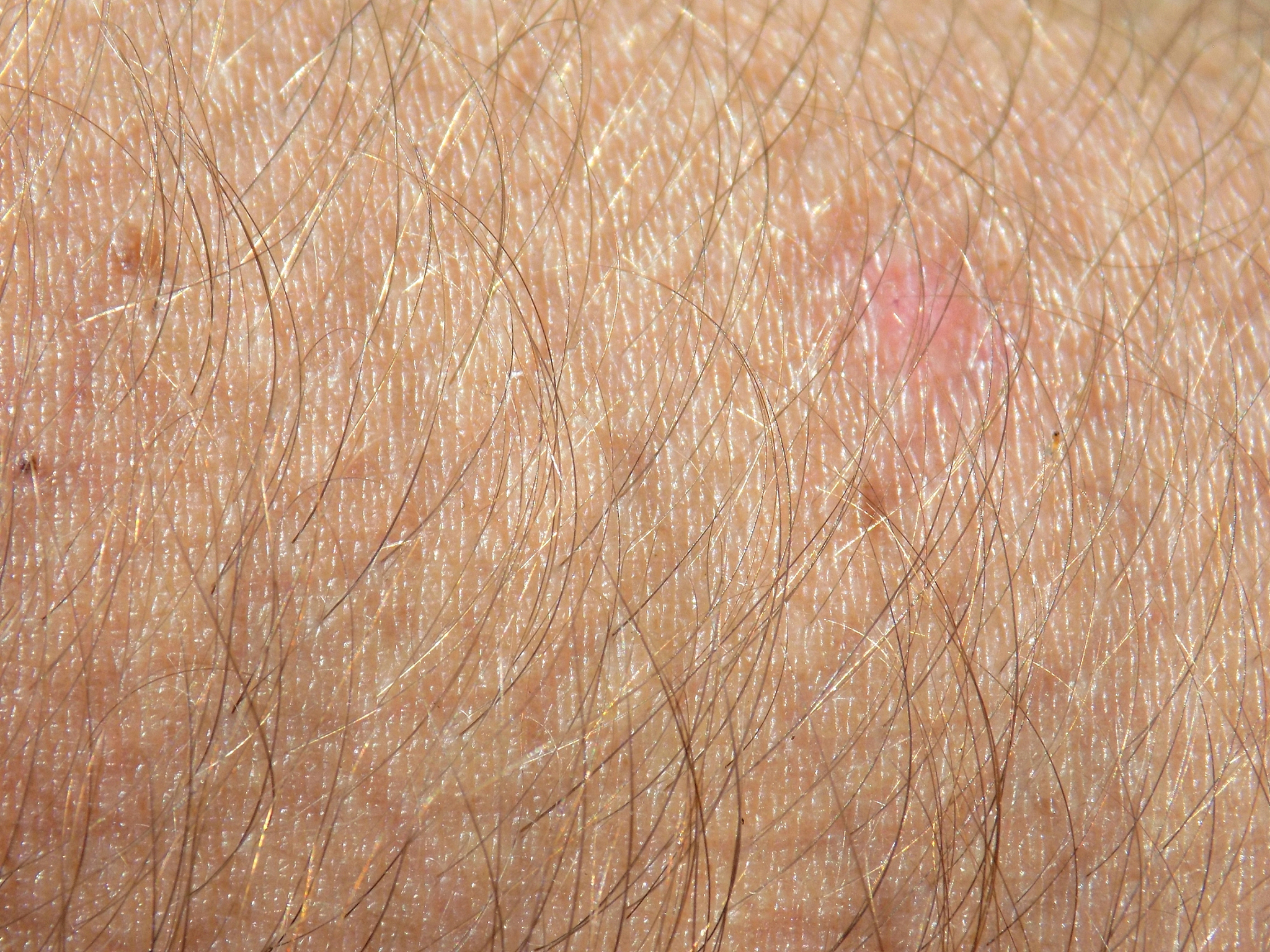 什么是毛囊炎有什么症状和危害