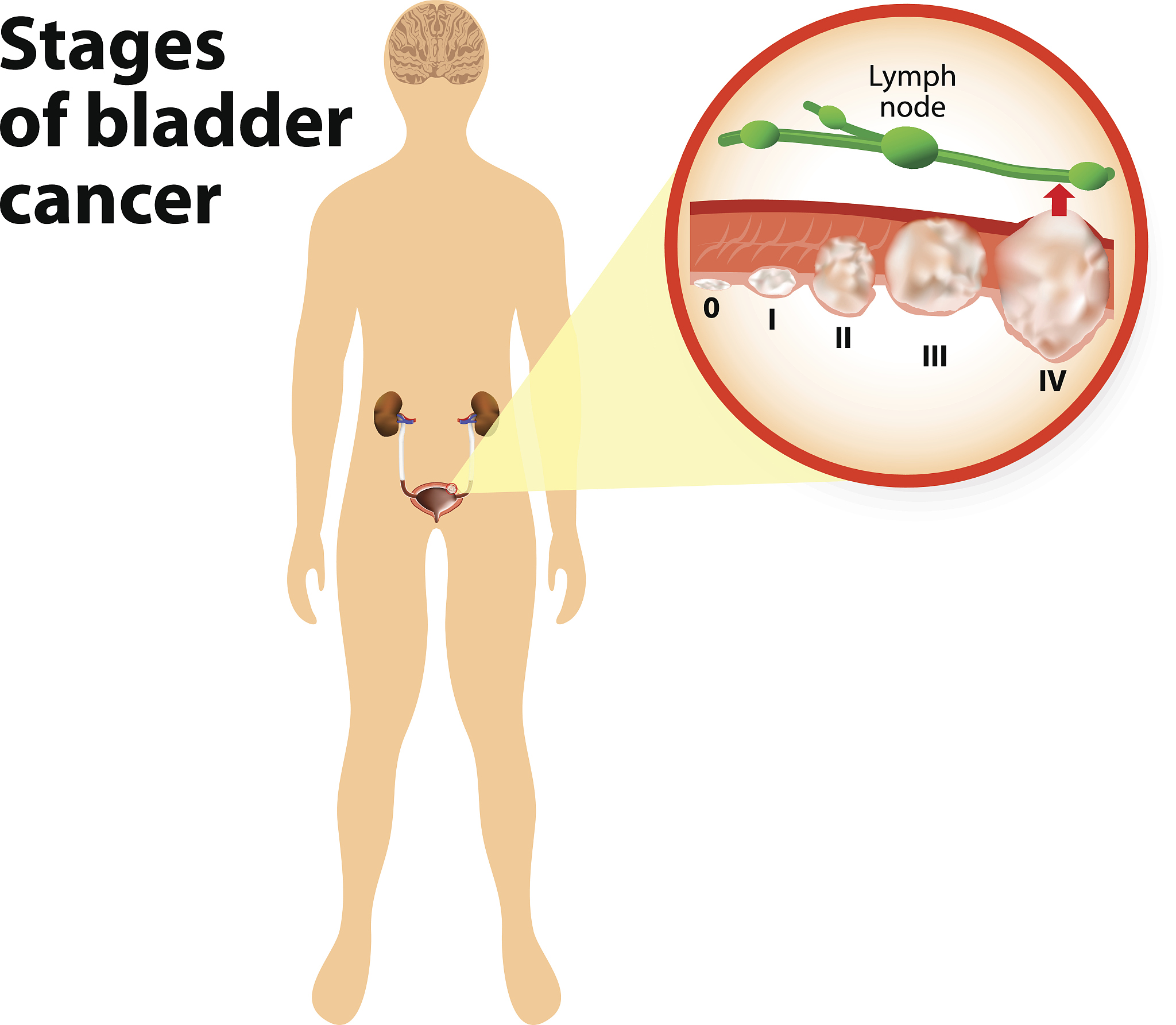 膀胱癌尿路造口并发症护理
