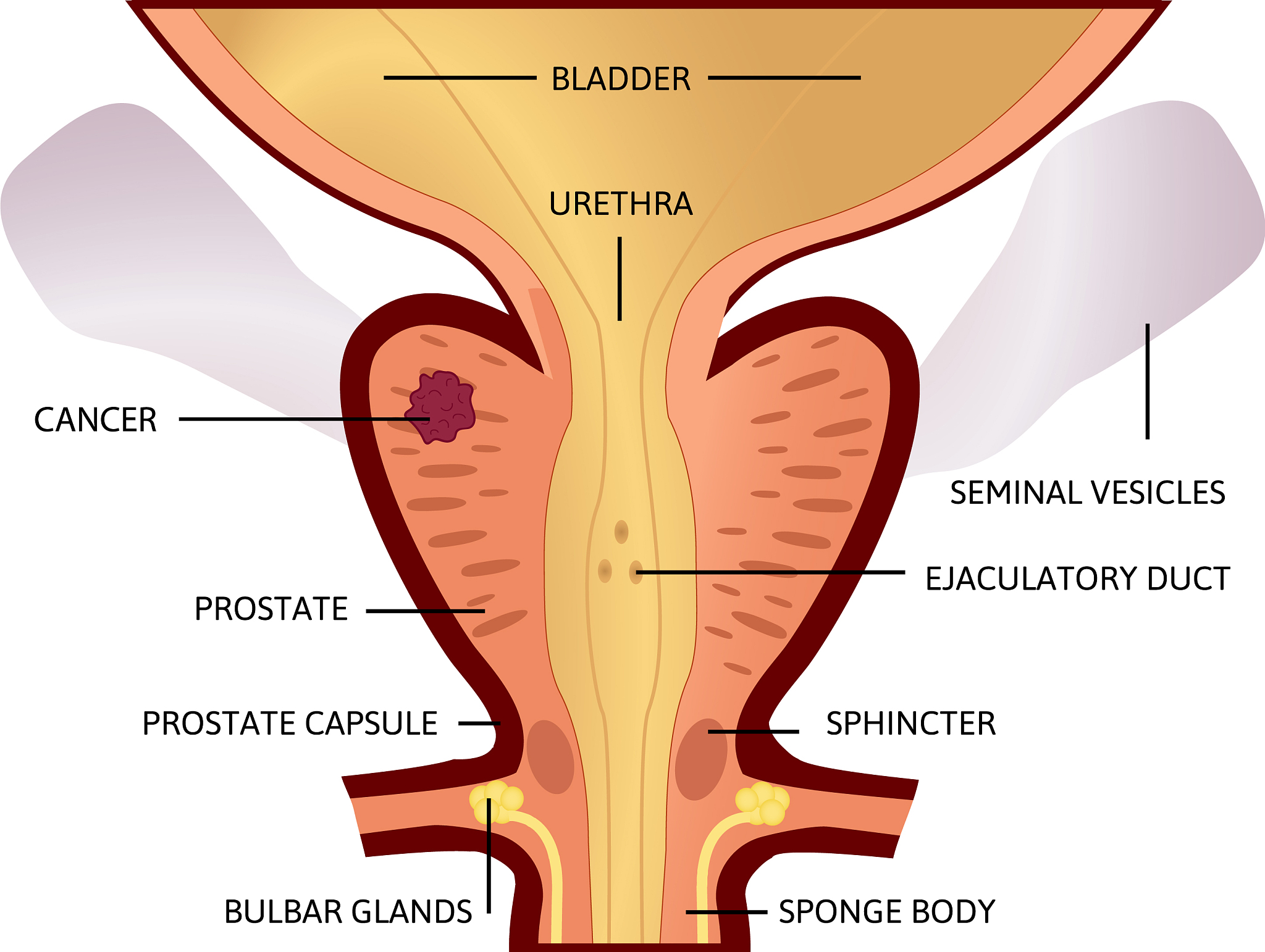 物理治疗师指导对根治性前列腺切除术后尿失禁的影响：PFME的益处和争议