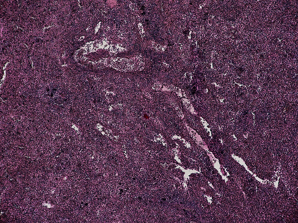 病理学教学文章内容详解：疾病定义、病理变化、临床表现及治疗