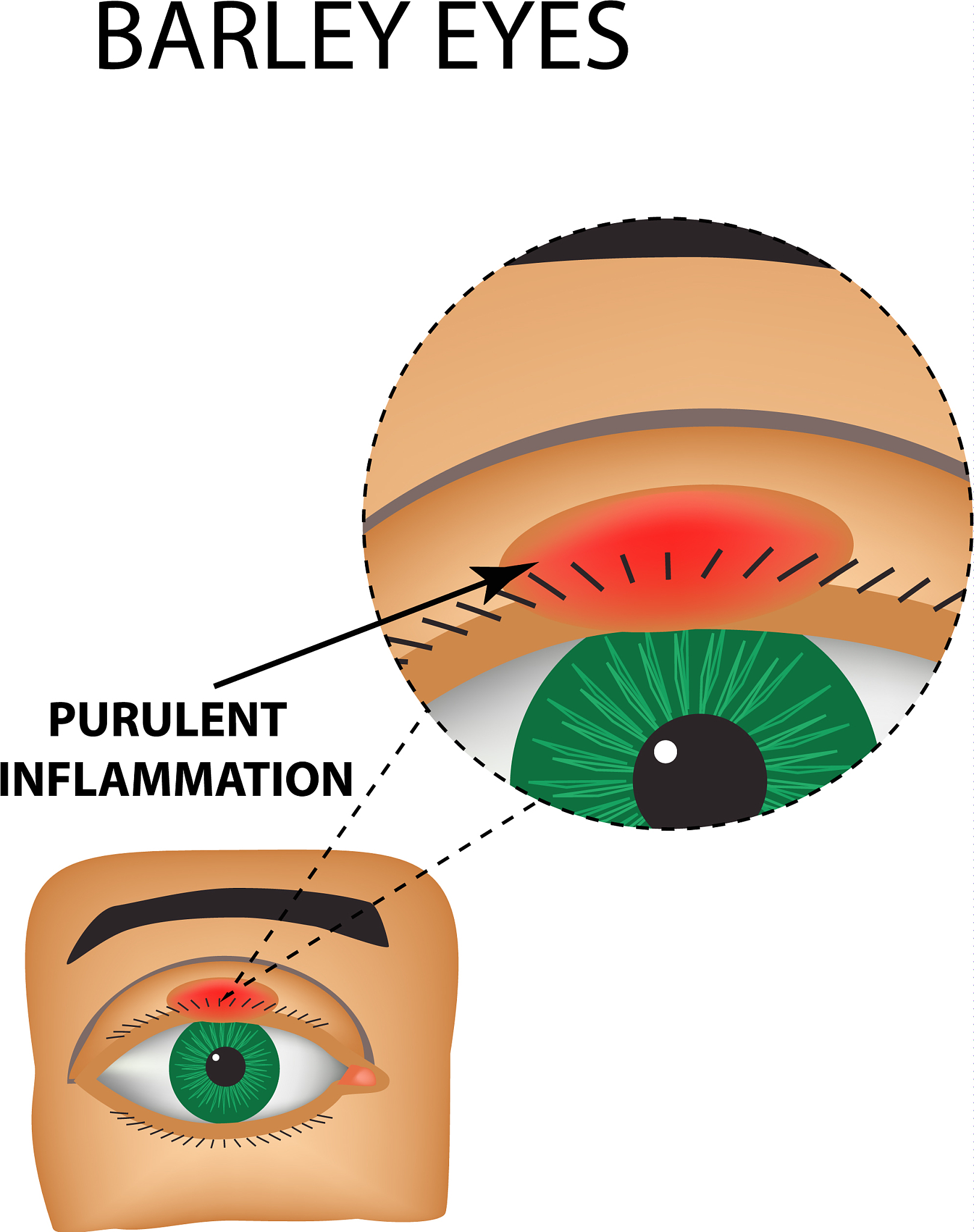 微小切口角膜基质透镜取出术后药物护理指南