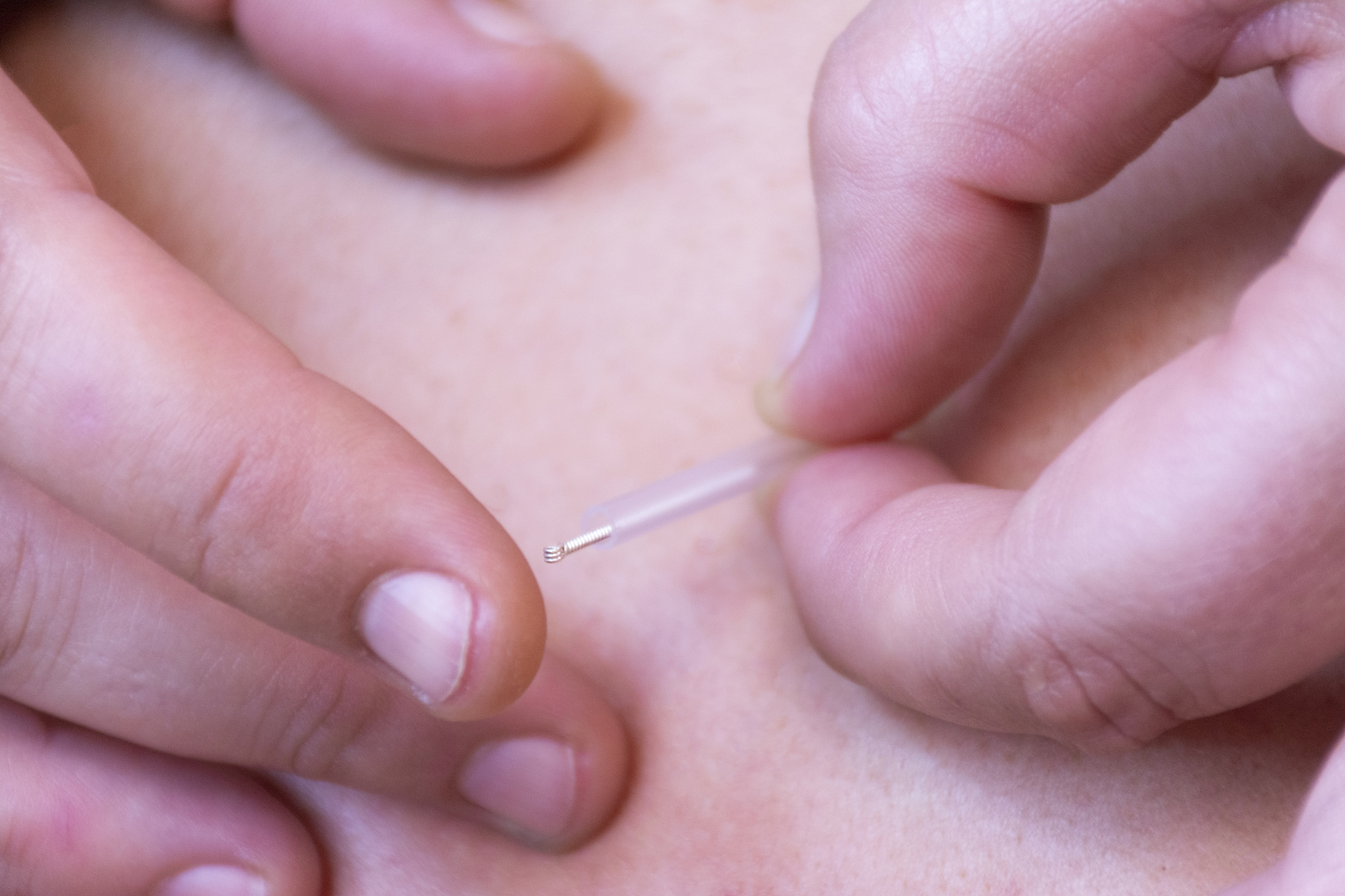 nailing an acupuncture needle