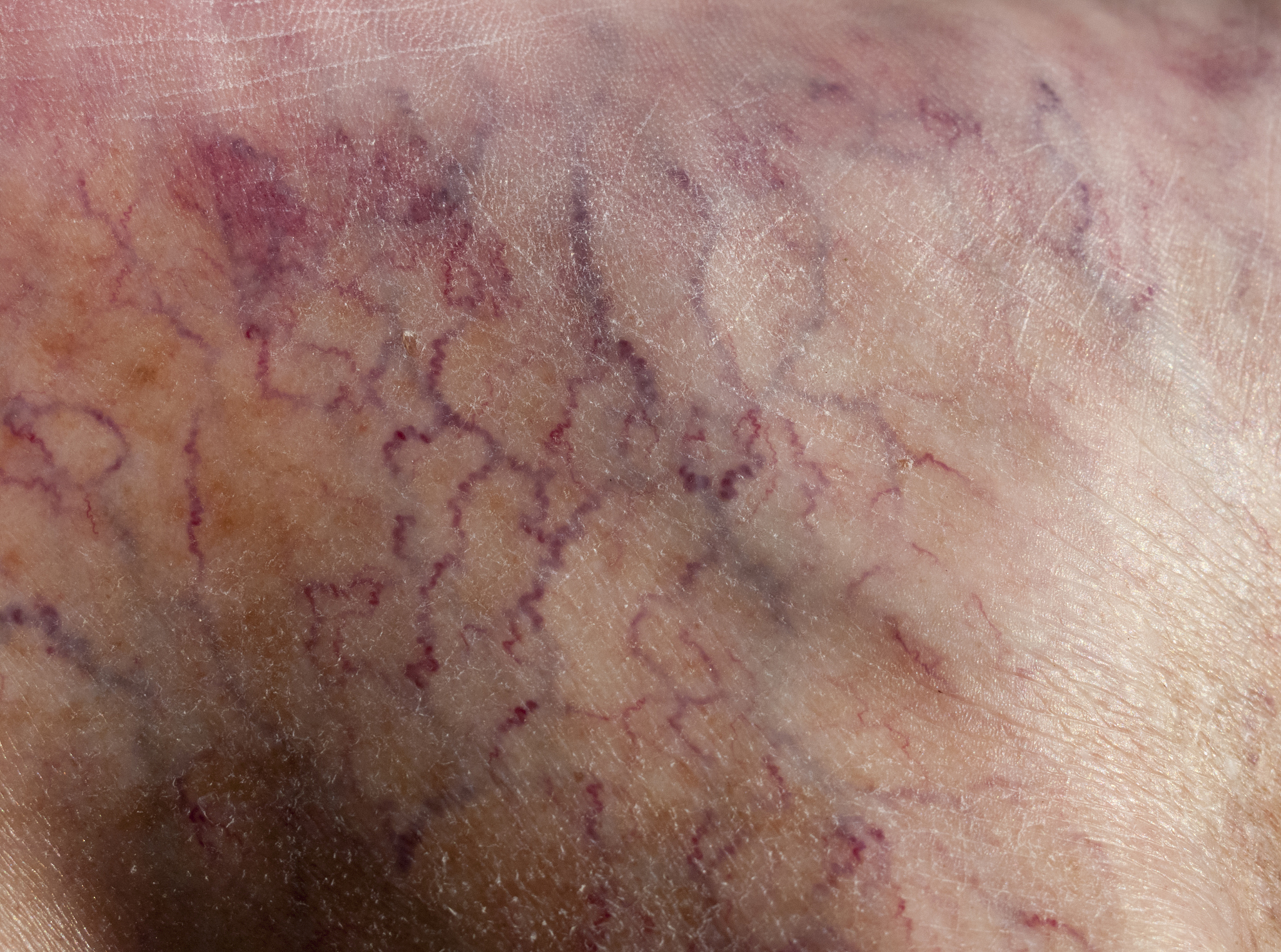 capillaries