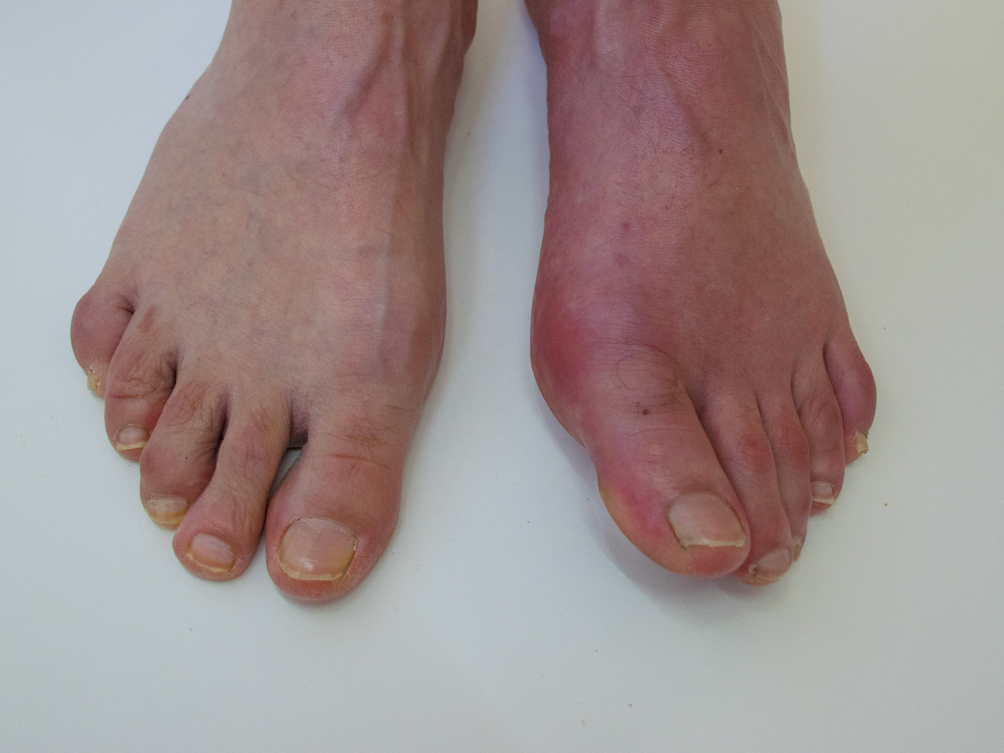 脚背痛脚趾发麻