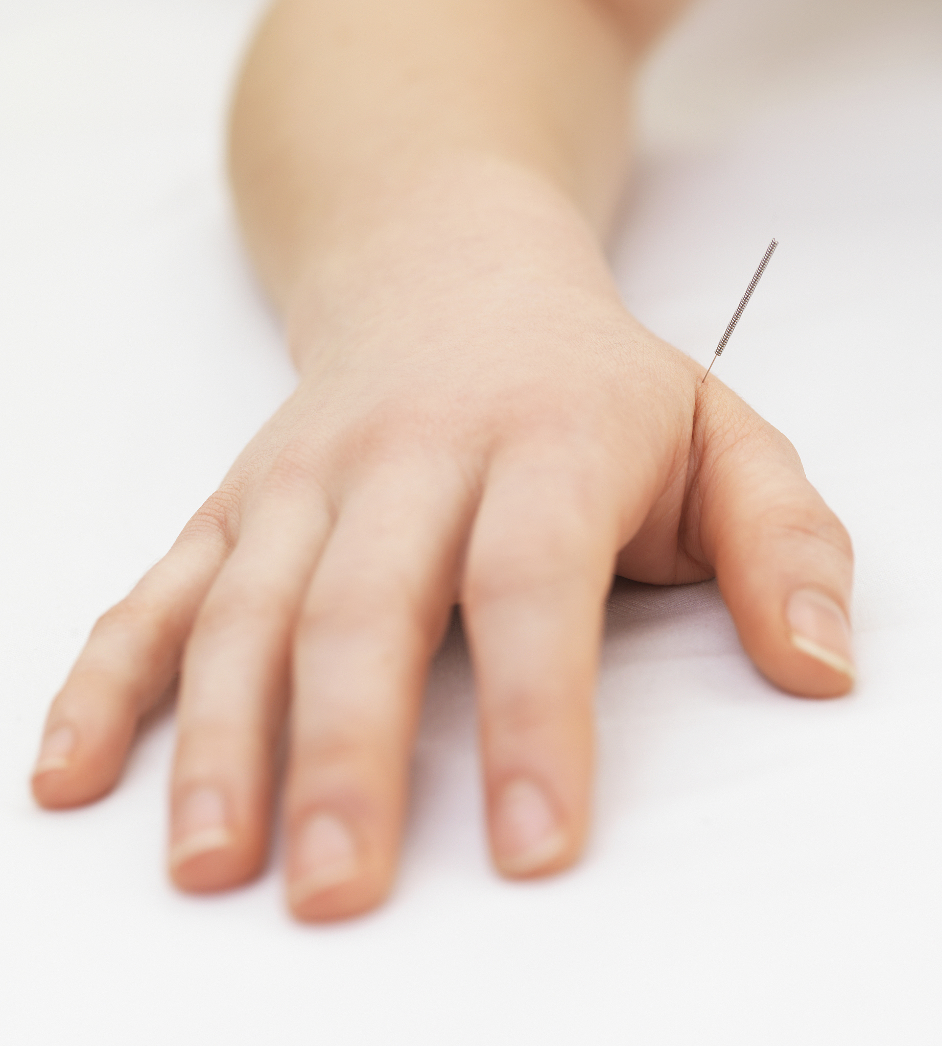 woman receiving acupuncture