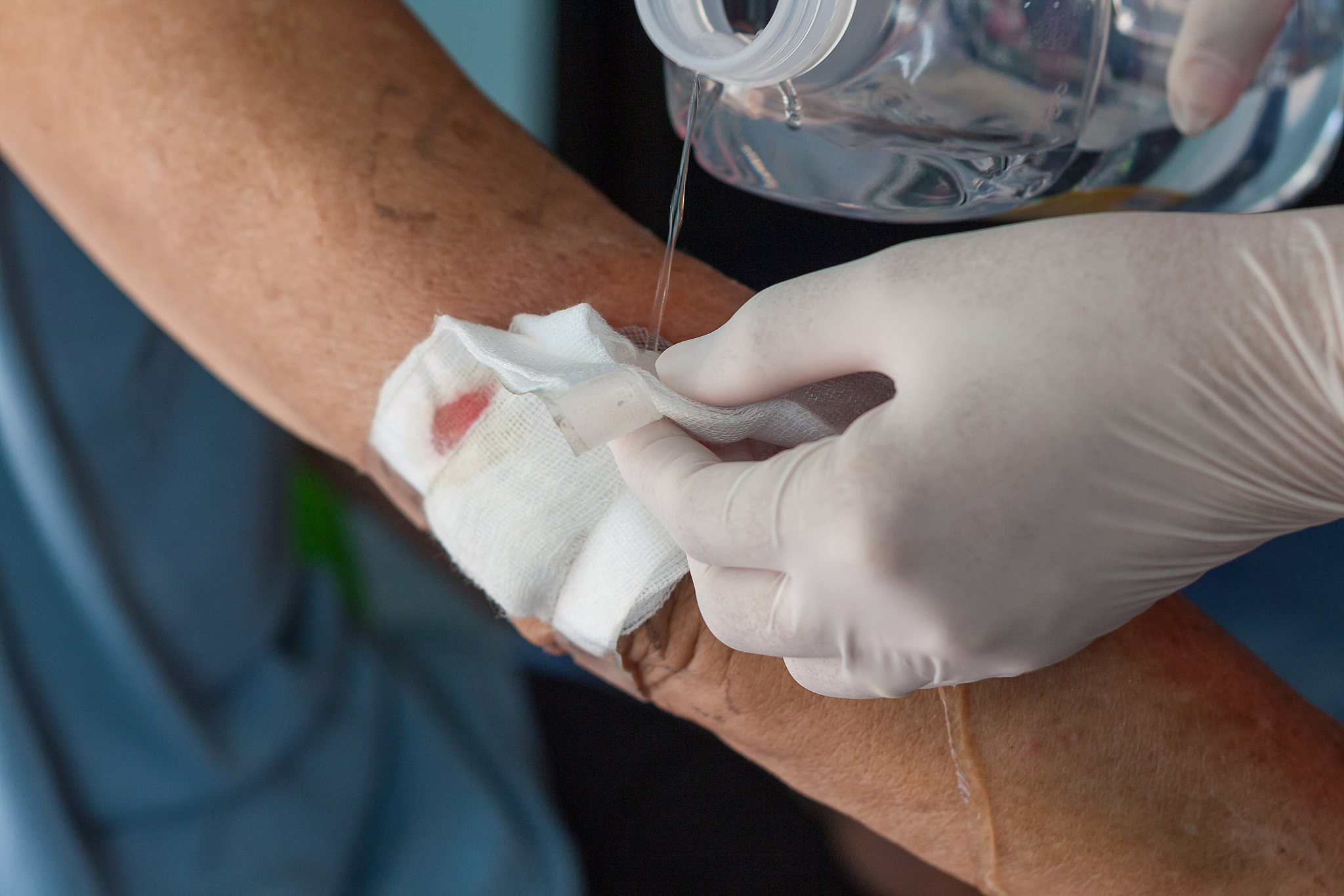 不同受伤部位的敷料选择指南