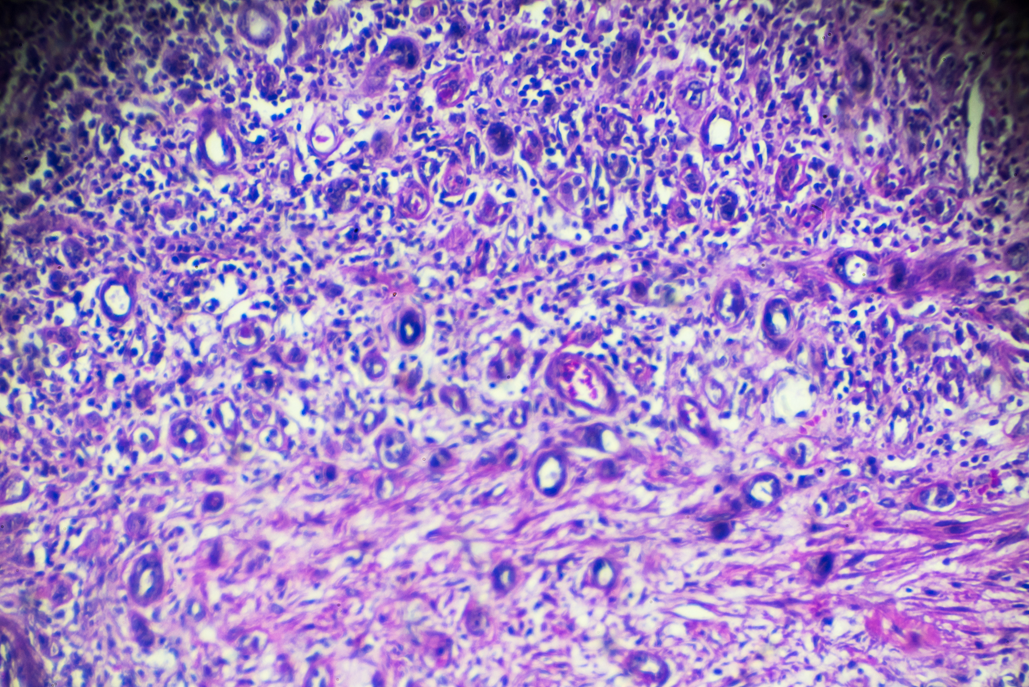 膜性肾病研究趋势：免疫机制、生物标志物、治疗策略