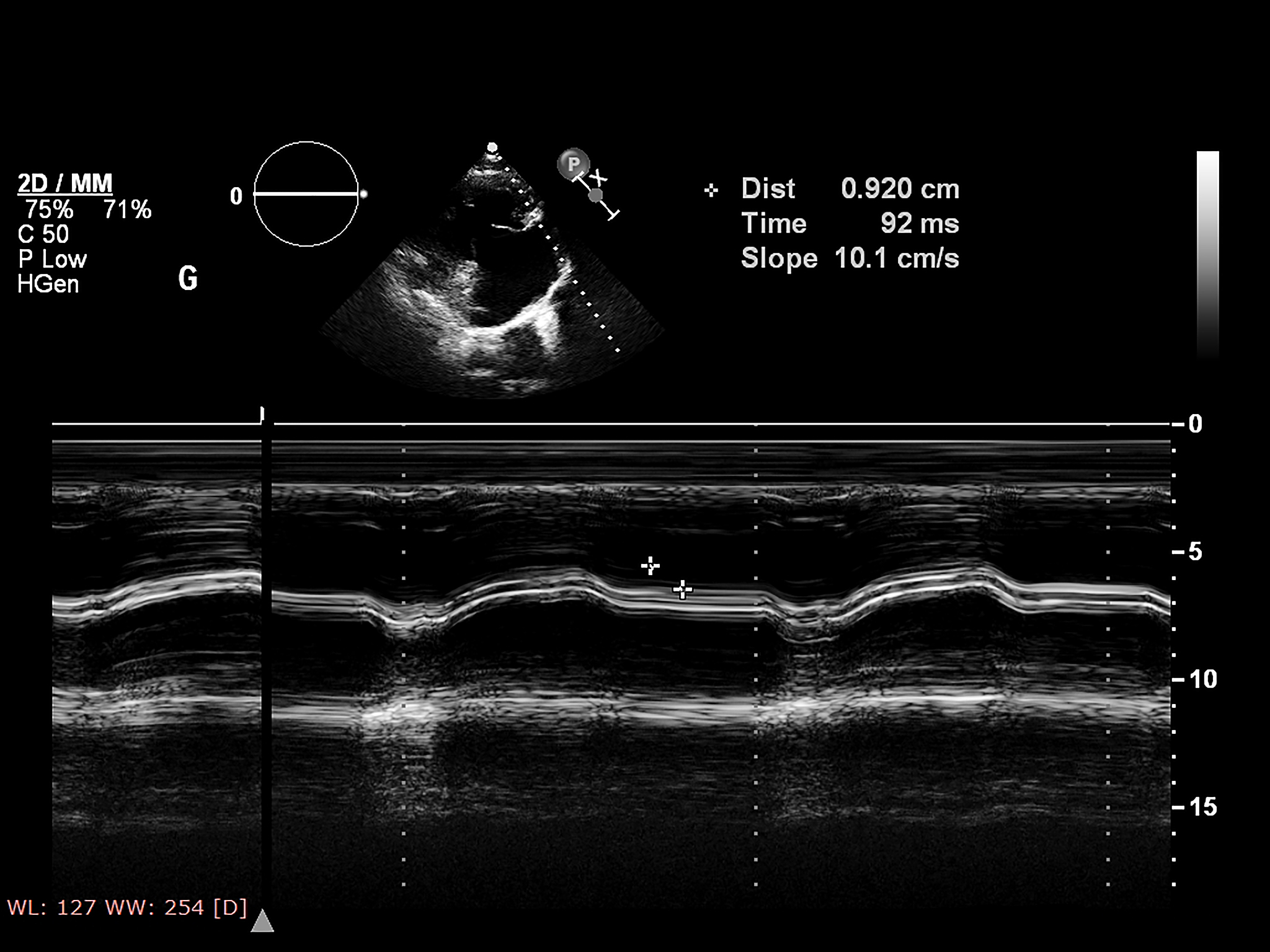 颈动脉超声检查：神经内科医生的常规操作