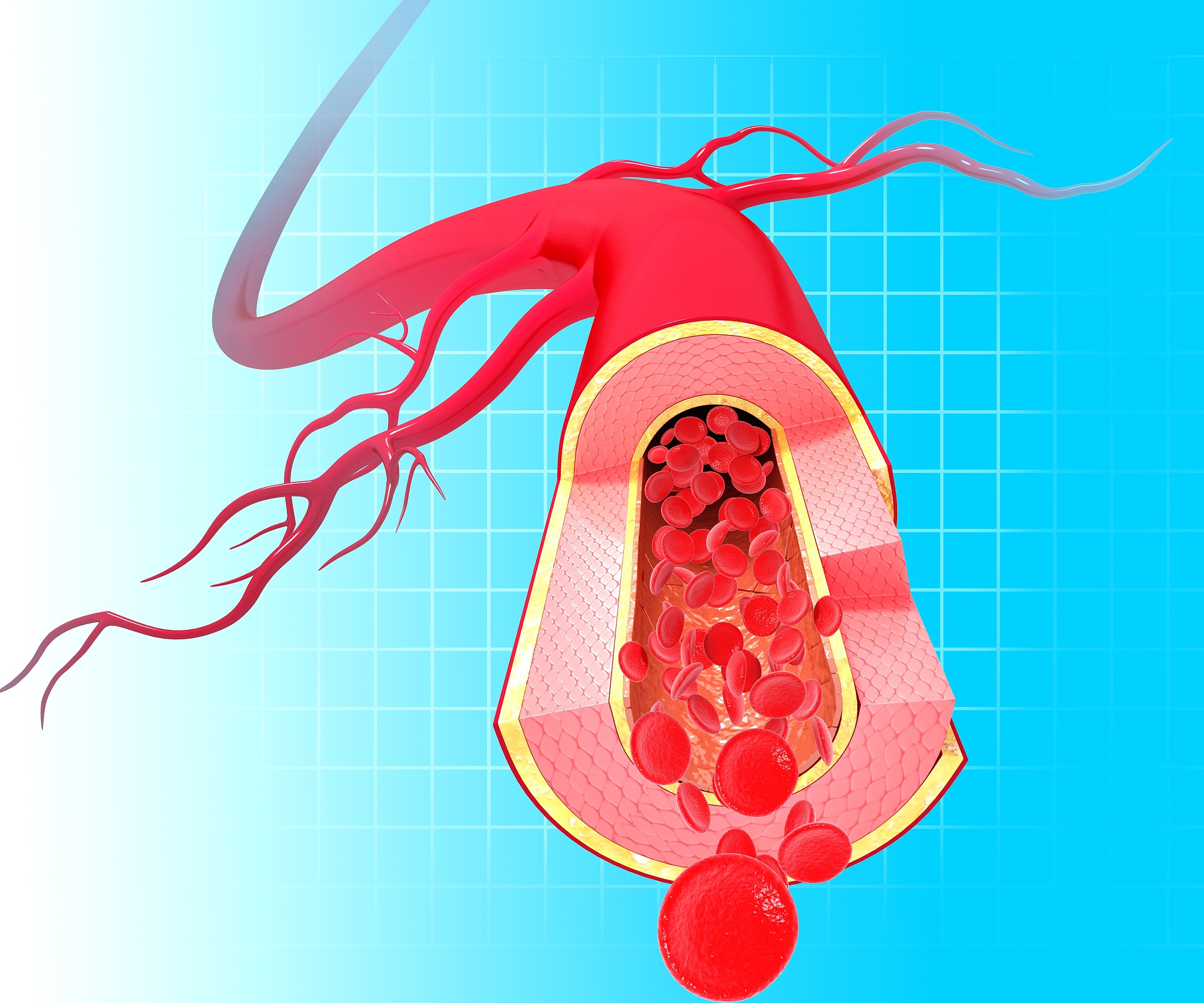 颈动脉斑块破裂导致卒中的连锁反应：新生血管、血栓和溃疡