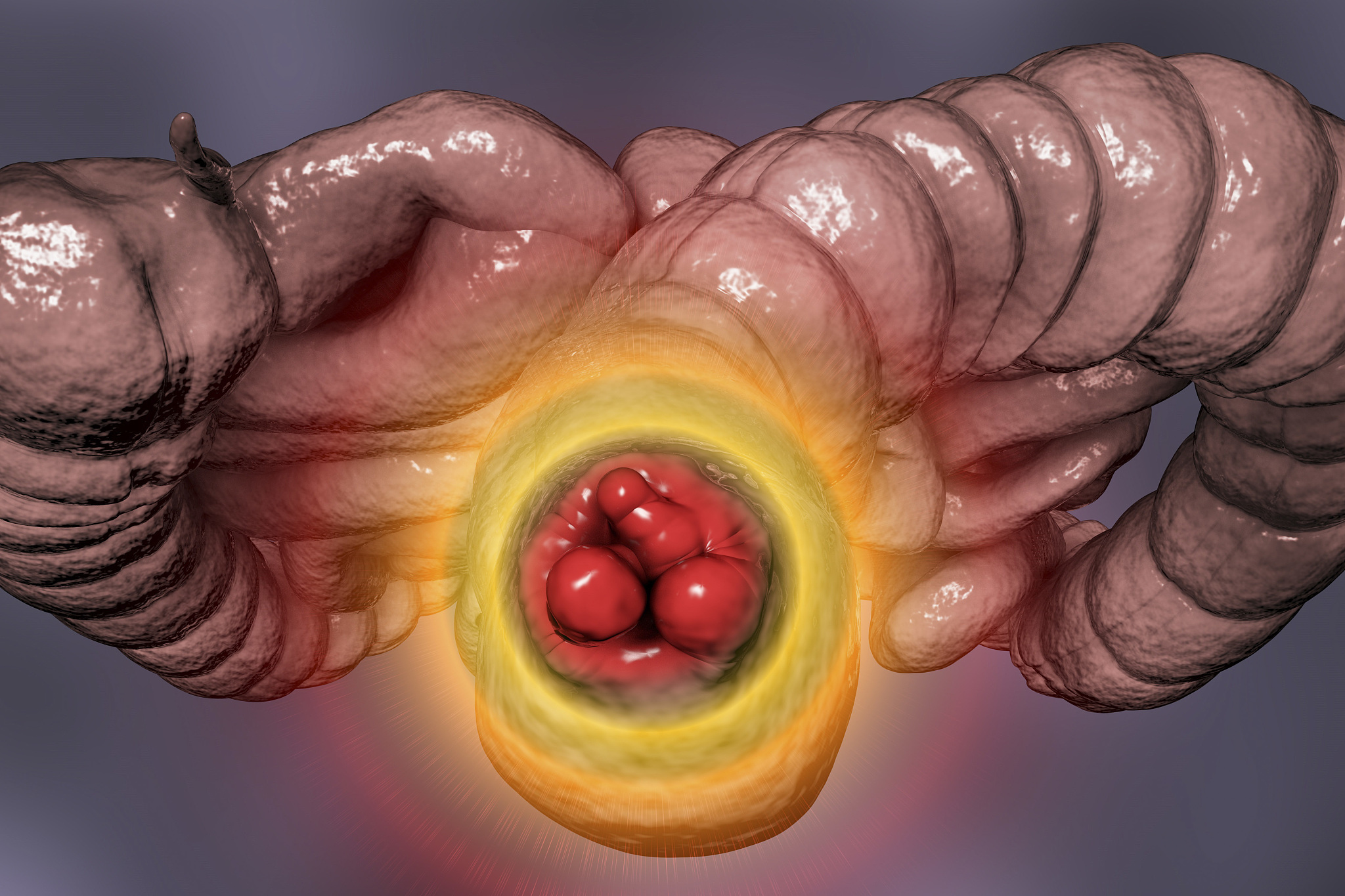 haemorrhoids, illustration