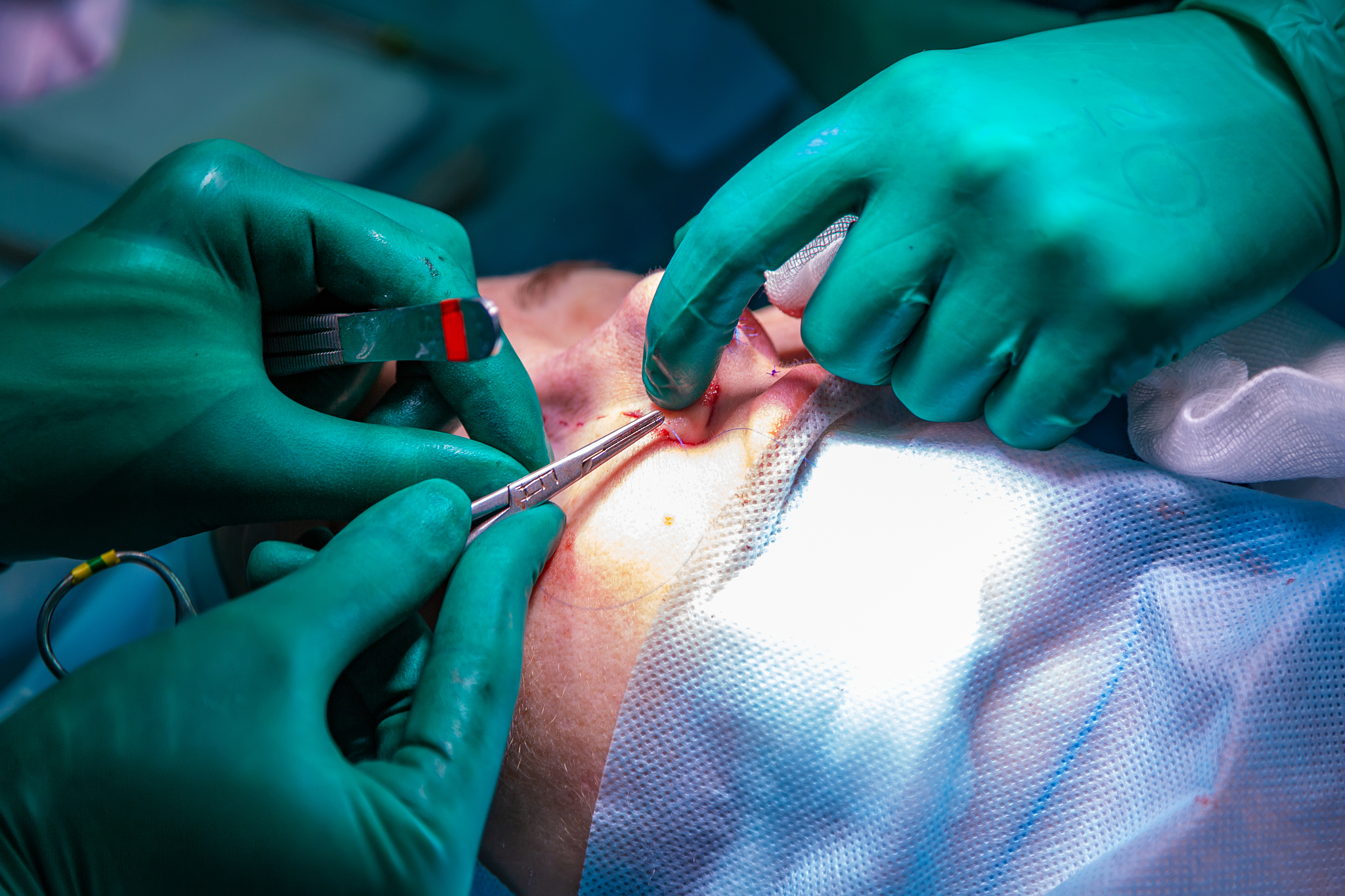 surgeon and his assistant performing cosmetic surgery on nose in