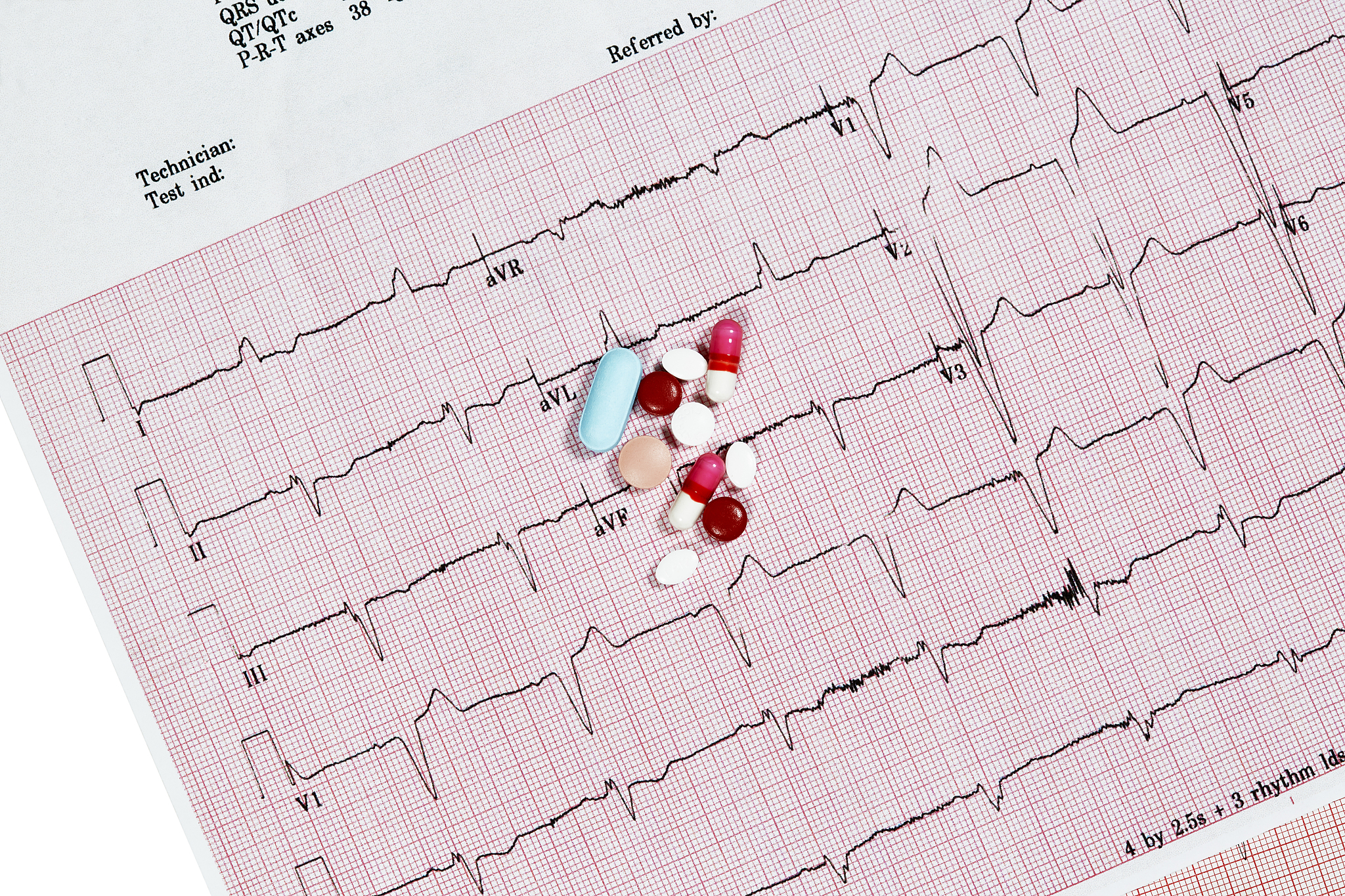 心肌缺血再灌注损伤：可逆的心肌功能障碍