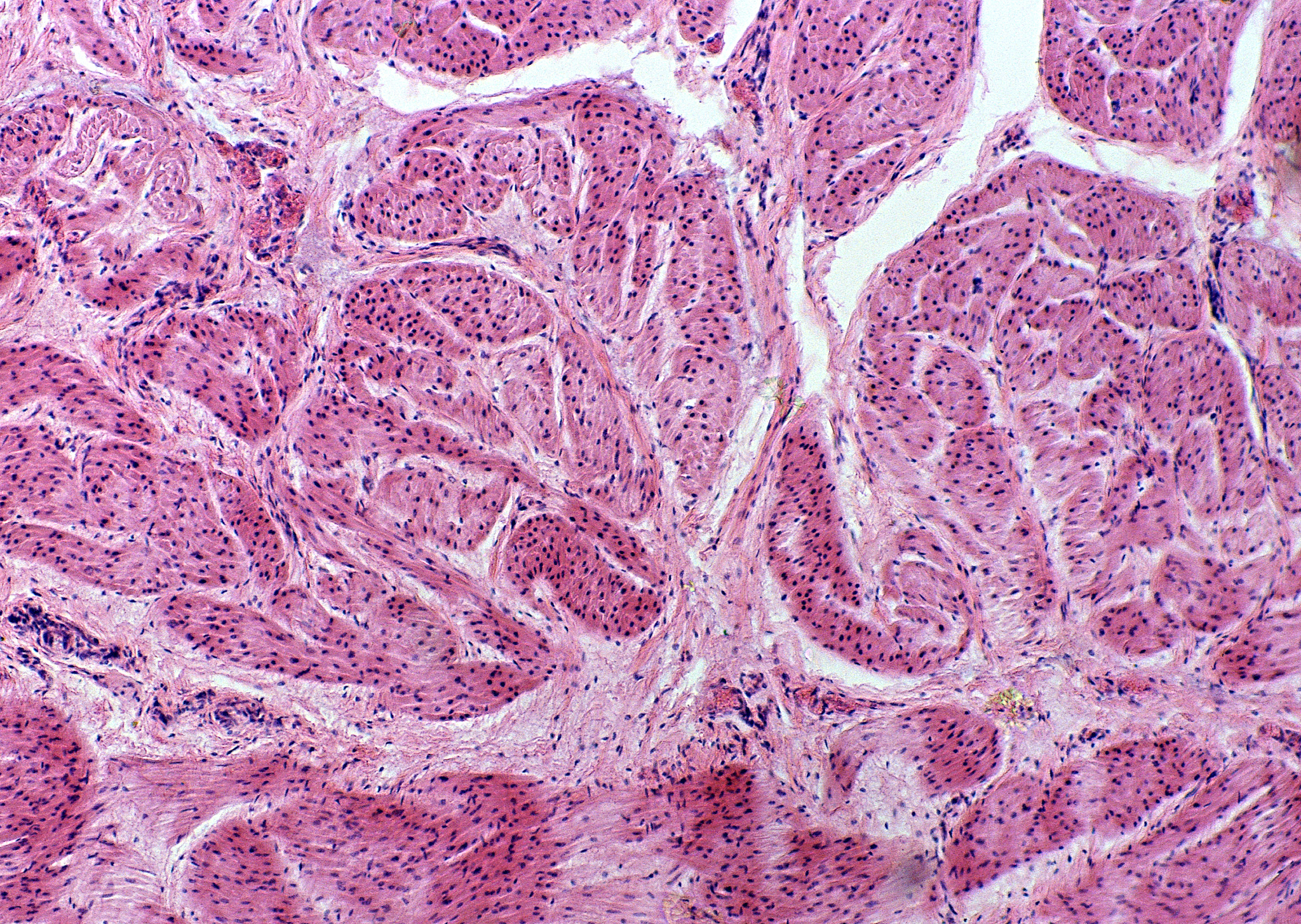 请修改下面这段话使其表达流畅且专业：WHO-HAEM5 描述了 FL 的三种形态学变体：1 经典 FL其特征在于中心细胞和中心母细胞的滤泡生长和 t14;18q32;q21IGHBCL2 融合； 2 滤泡性大 B 细胞淋巴瘤对应于 WHO-HAEM4 FL 3B 级很少携带 BCL2 易位。 滤泡型常与 DLBCL 面积共存。 当 MUM1IRF4 强表达时需要对 IRF4 进行 FISH 分析