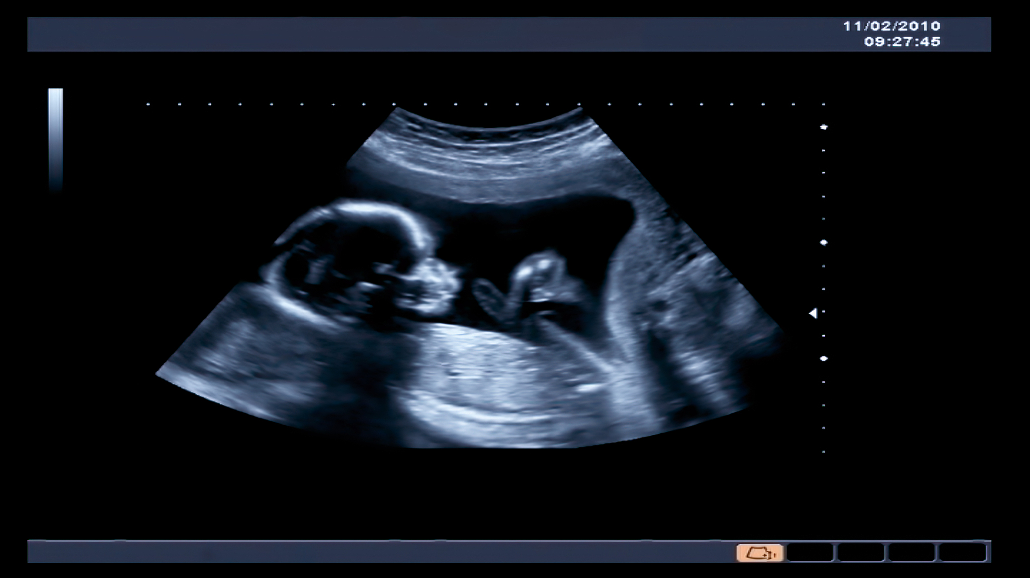 obstetric ultrasonography. echography of a fourth month fetus