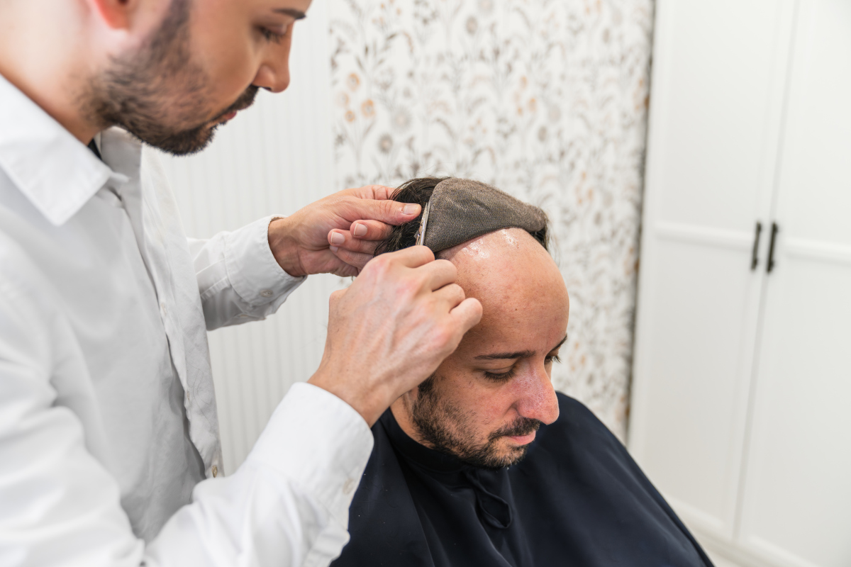 头发种植：多久能看到效果？ | 脱发治疗指南