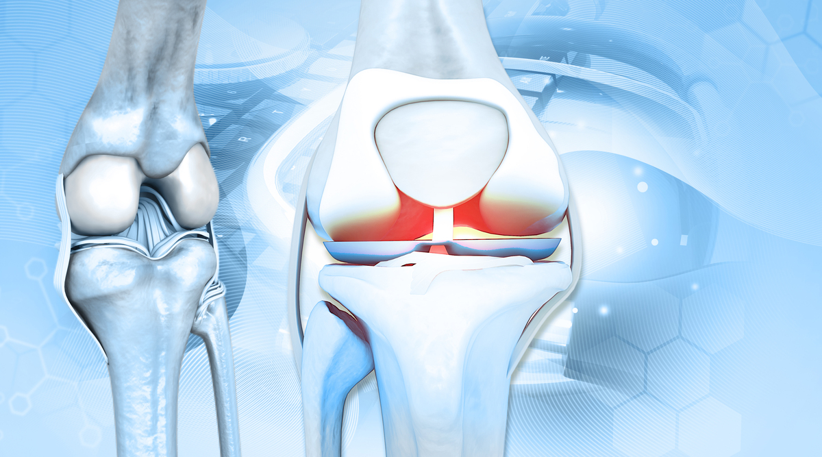膝关节骨性关节炎的流行病学