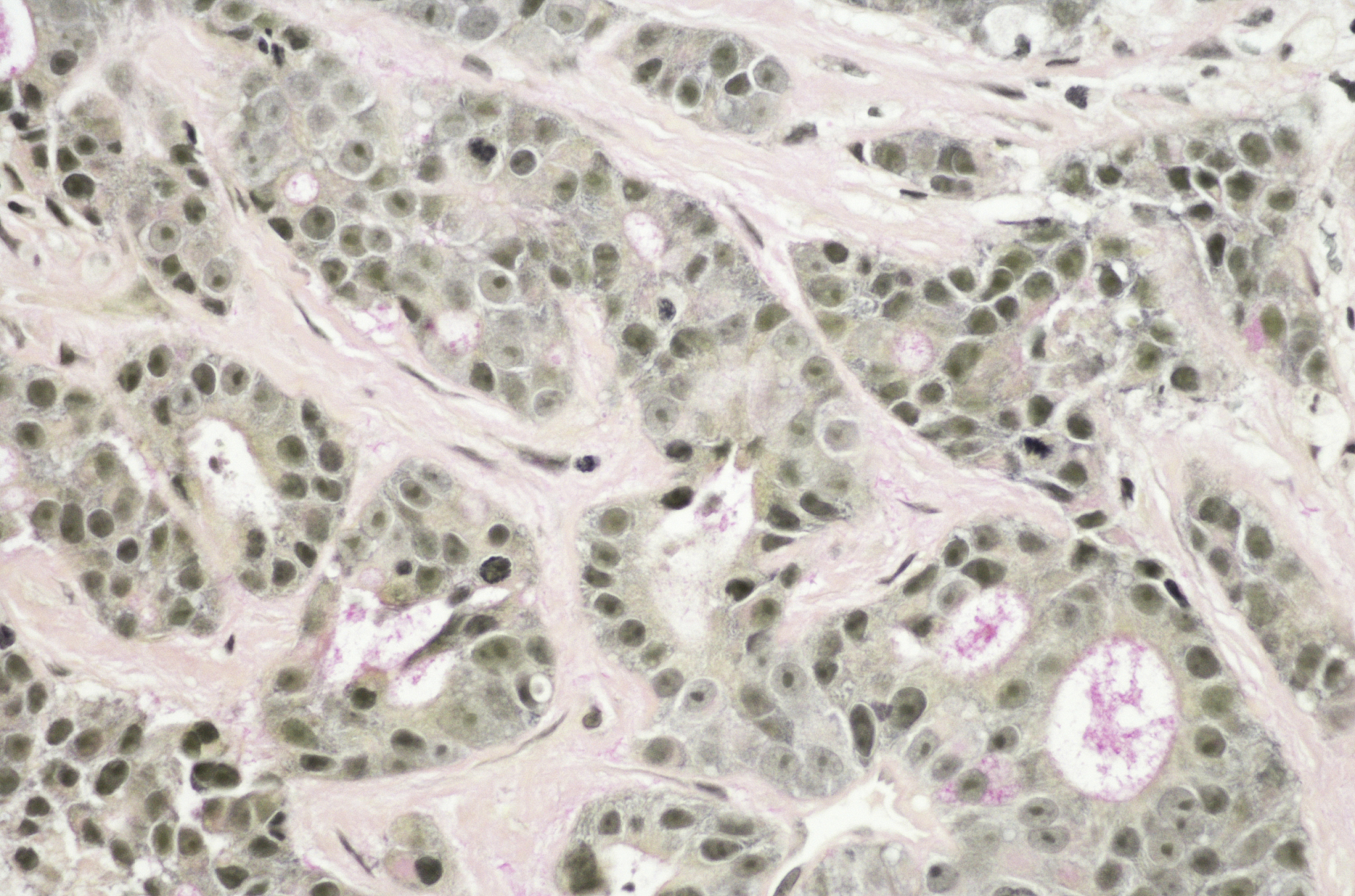 浸润性粘液腺癌2b期的预后