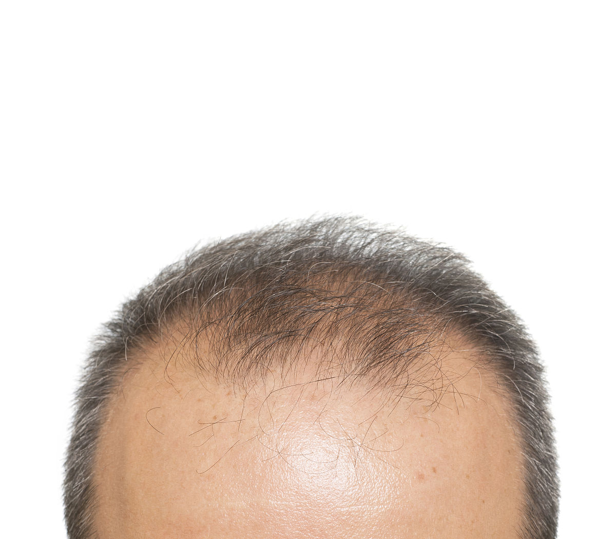 发际线高怎么办