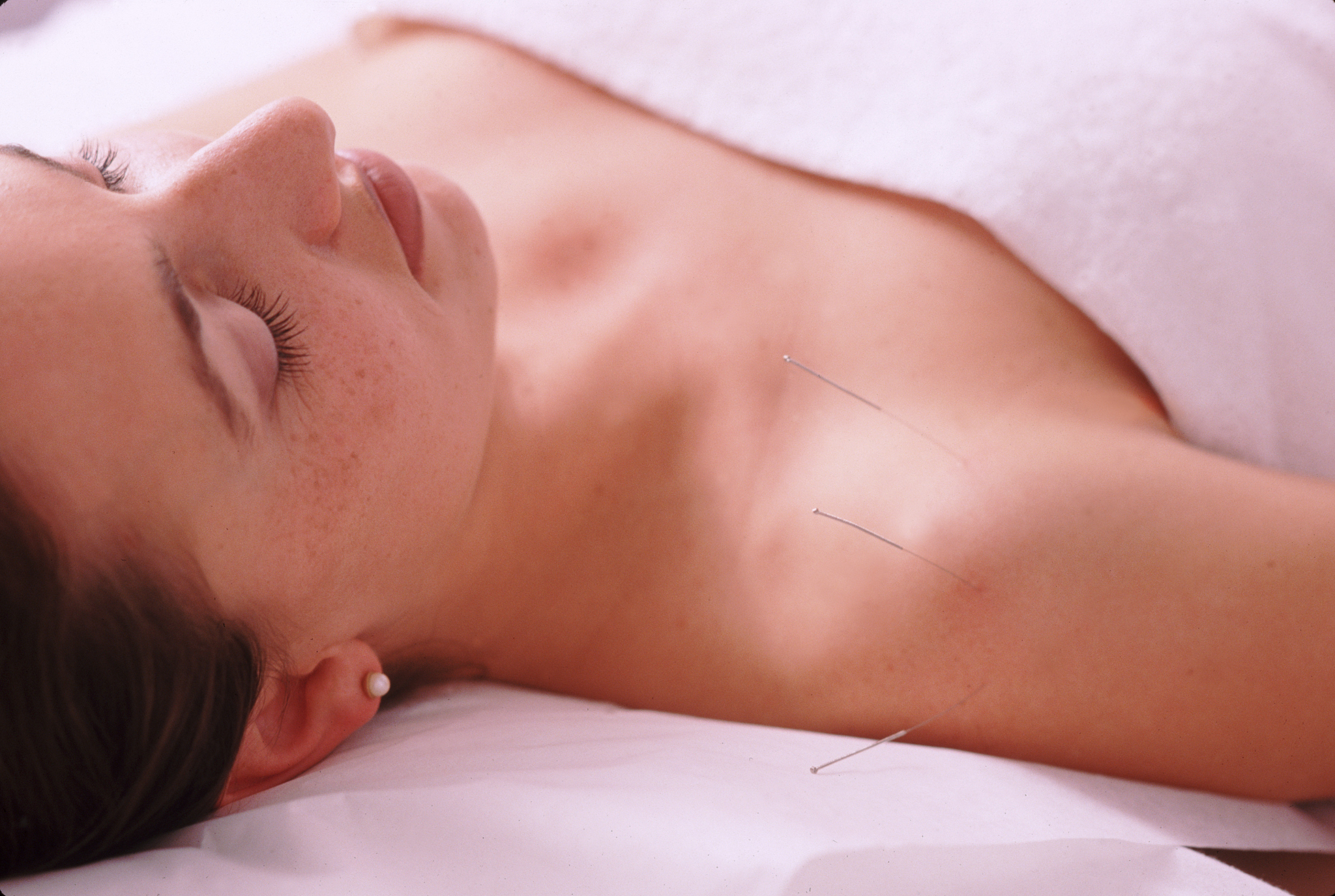 acupuncture for shoulder pain