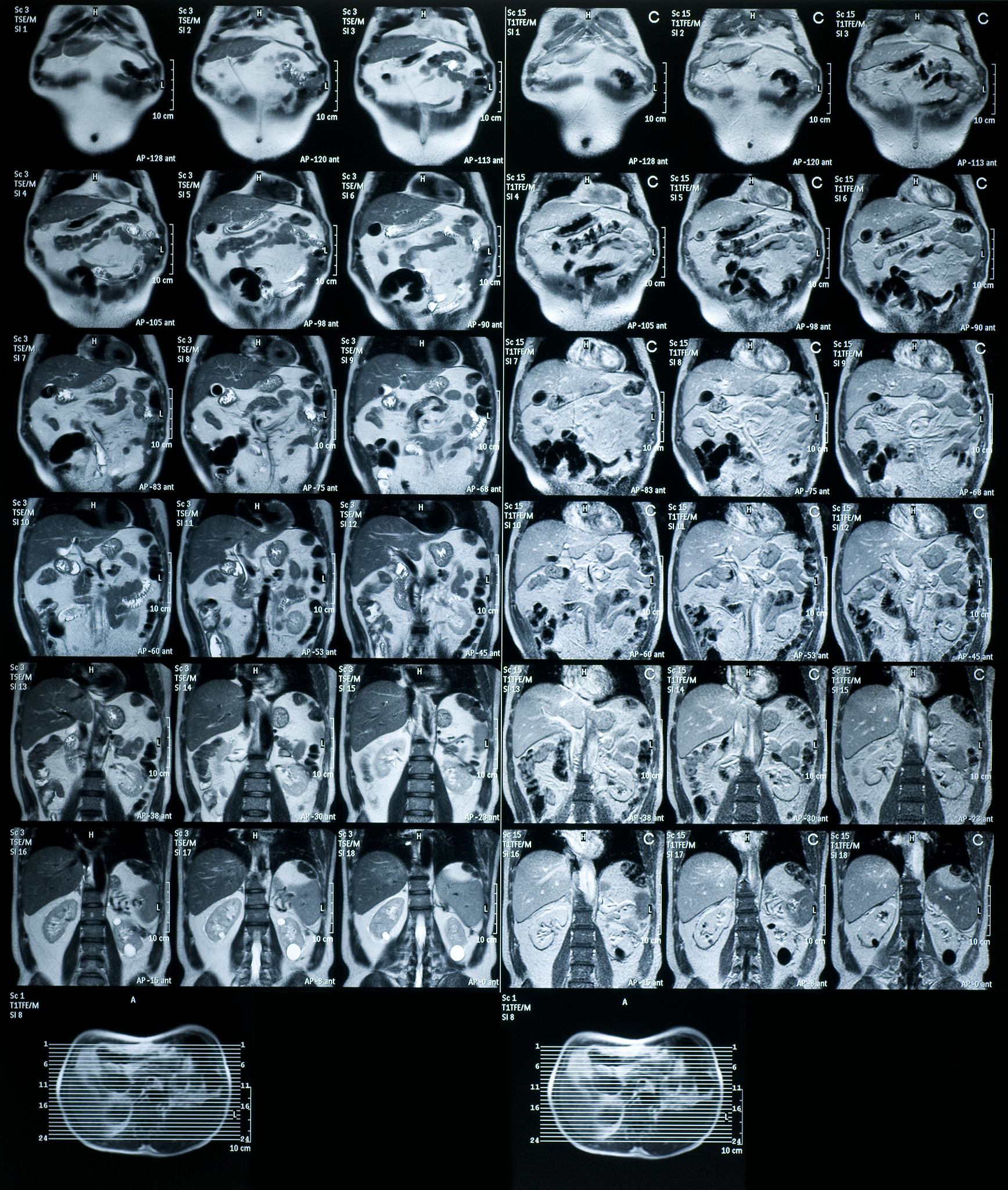 结节增强强化程度解读：轻度强化和中度强化意味着什么？