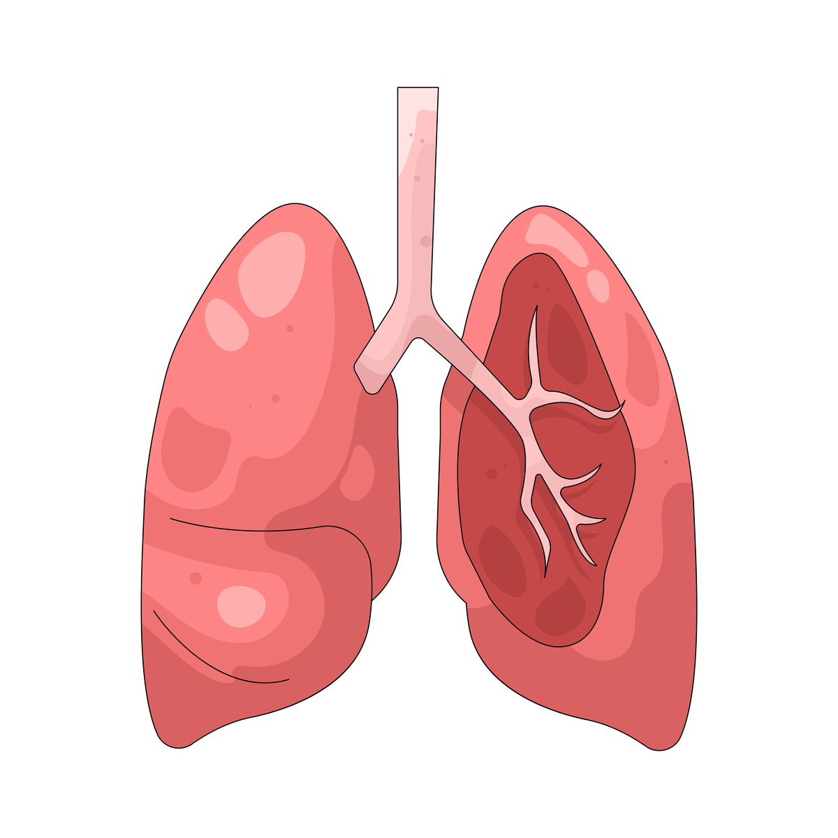 血性胸腔积液的原因：肺癌、感染、肺栓塞等