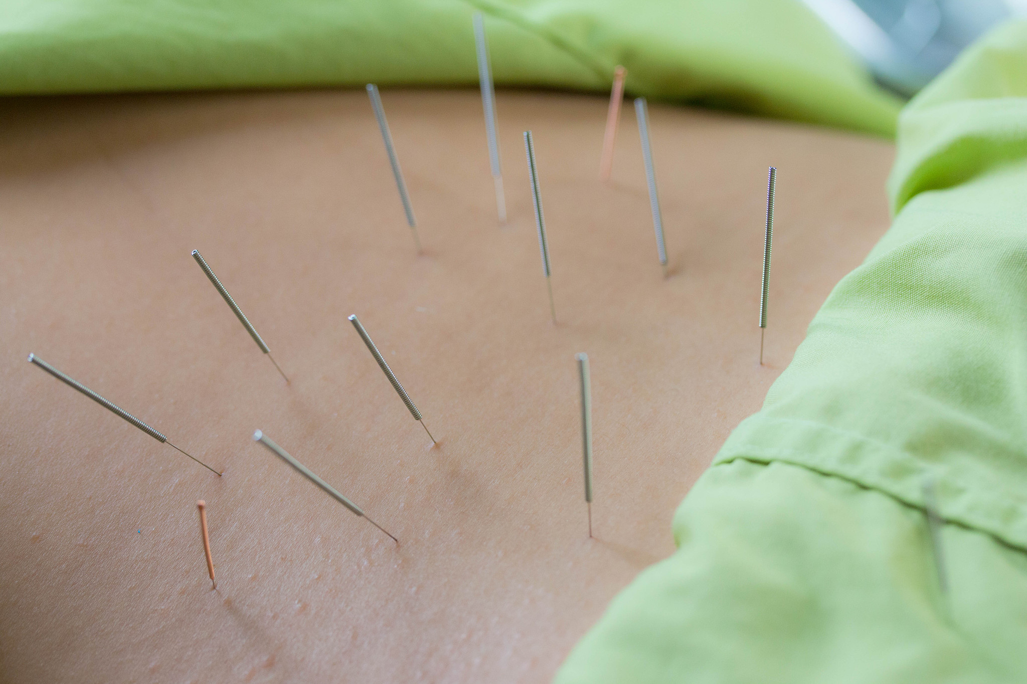 close-up of woman with acupuncture needles
