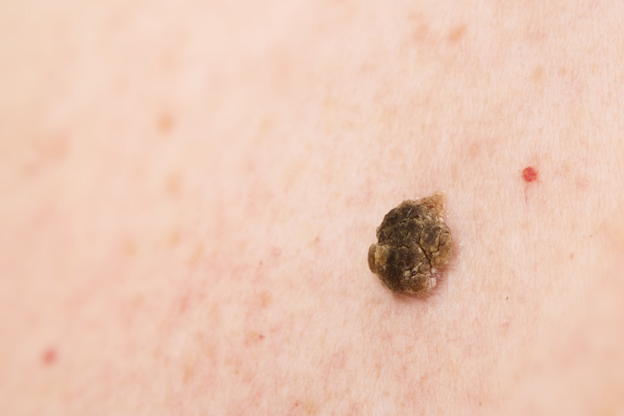 seborrheic keratosis, narrow focus