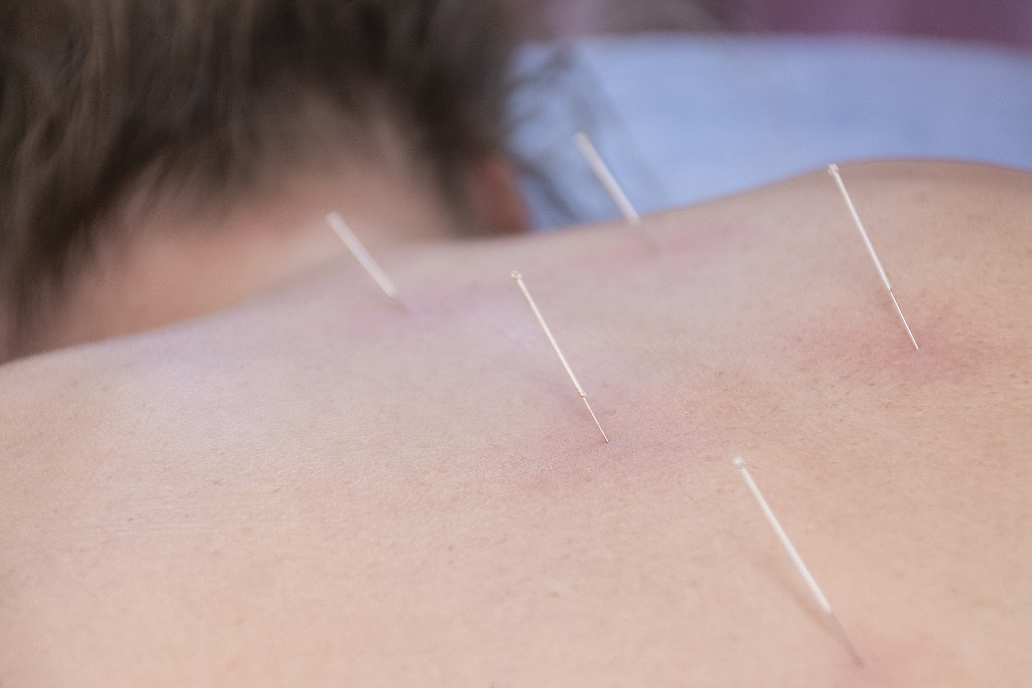 some acupuncture needles on the back