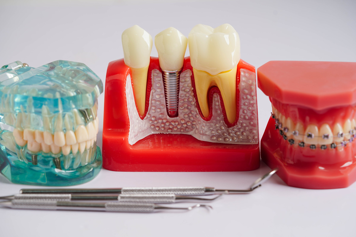 烤瓷牙可以取下来吗？详细解读与注意事项