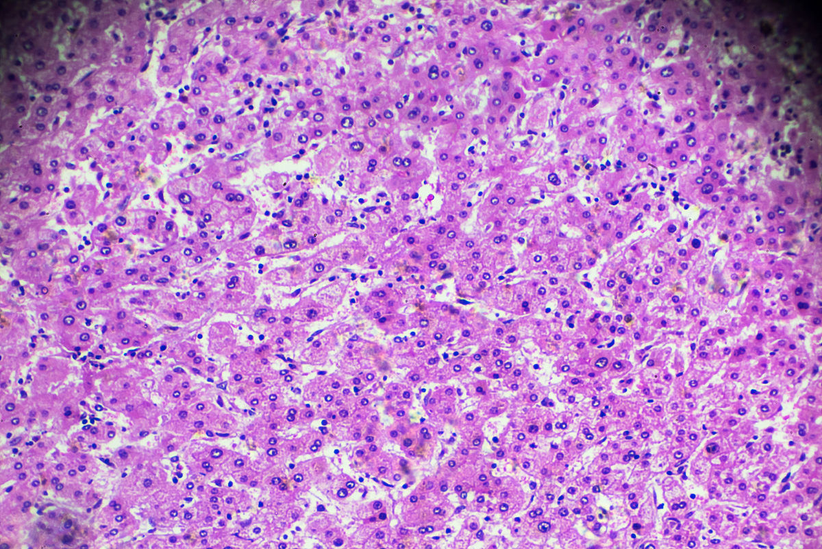 HCC组织模型评分显著区别于正常肝组织