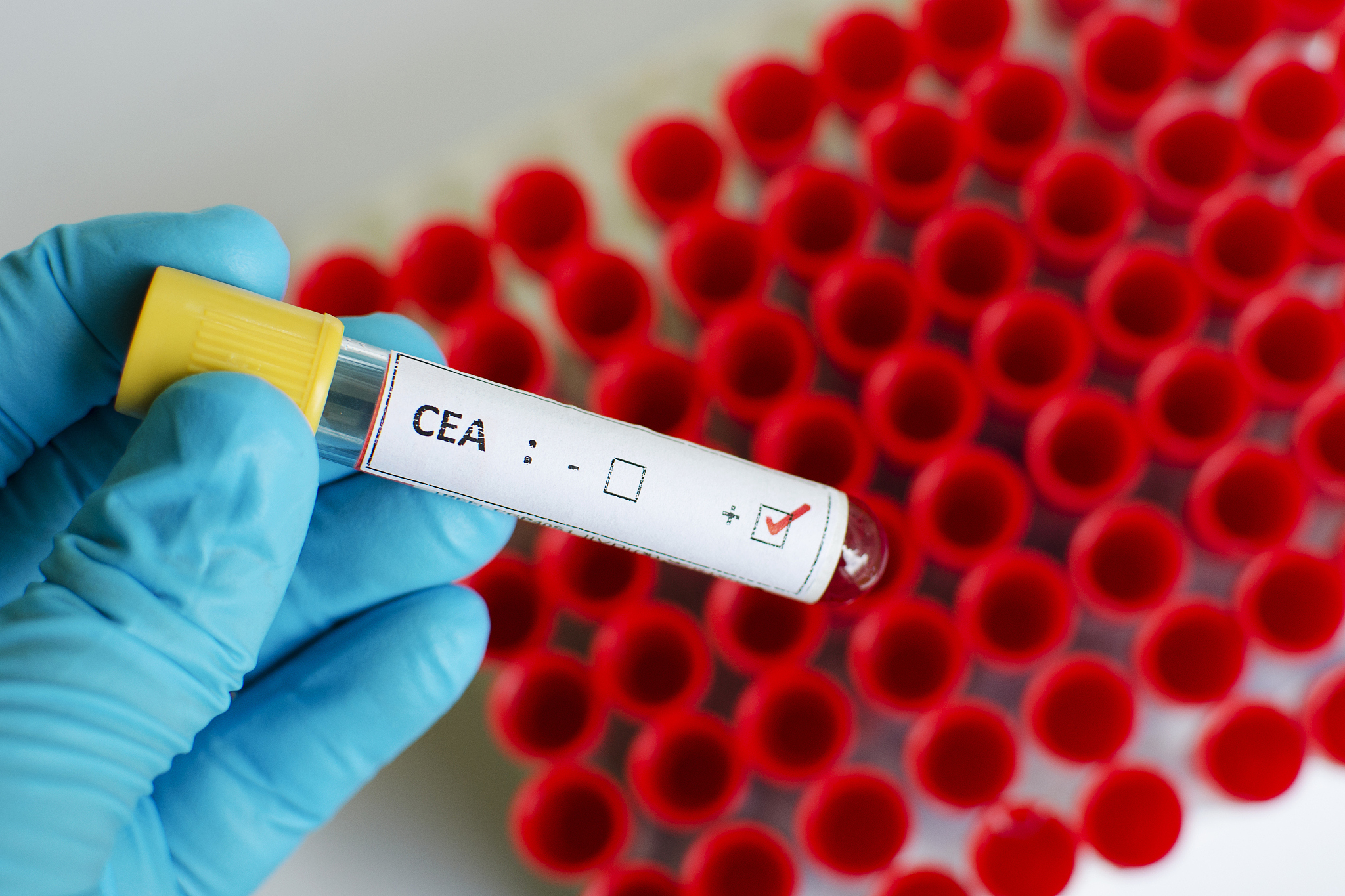 请为本人攥写述职报告本人为上海市肿瘤所研究员与仁济医院胃肠外科团队签订合同为兼聘人员。需从以下几方面展开1开展工作汇报、2已取得的工作成绩、3未完成工作的原因分析4下一步工作计划。