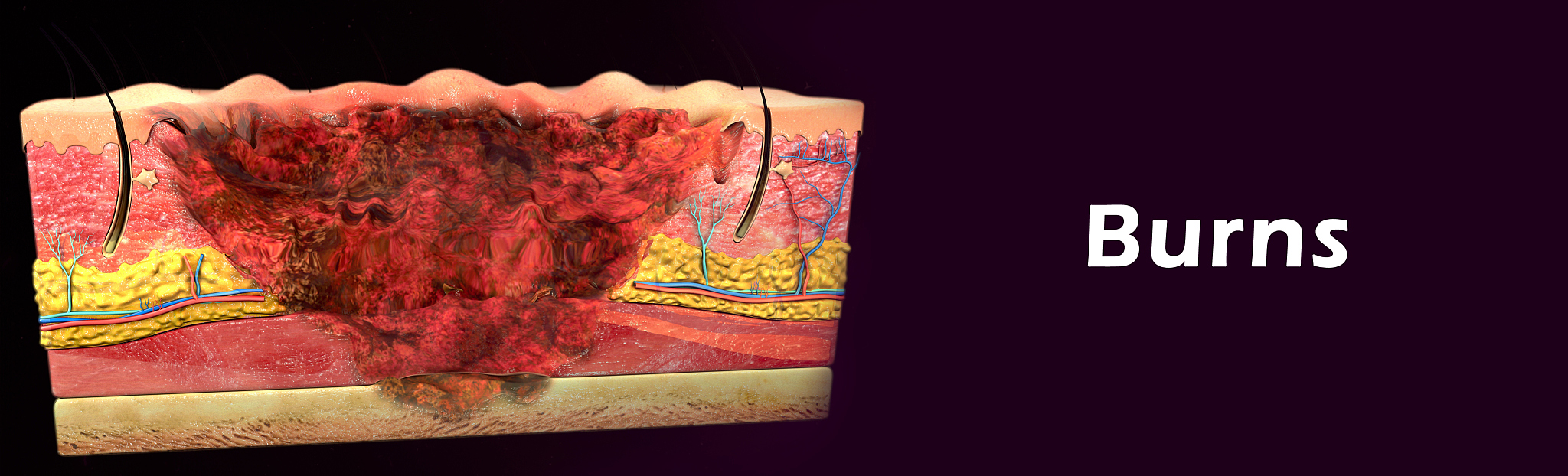 CEUS在斑块观察中的应用：新生血管、溃疡和血栓