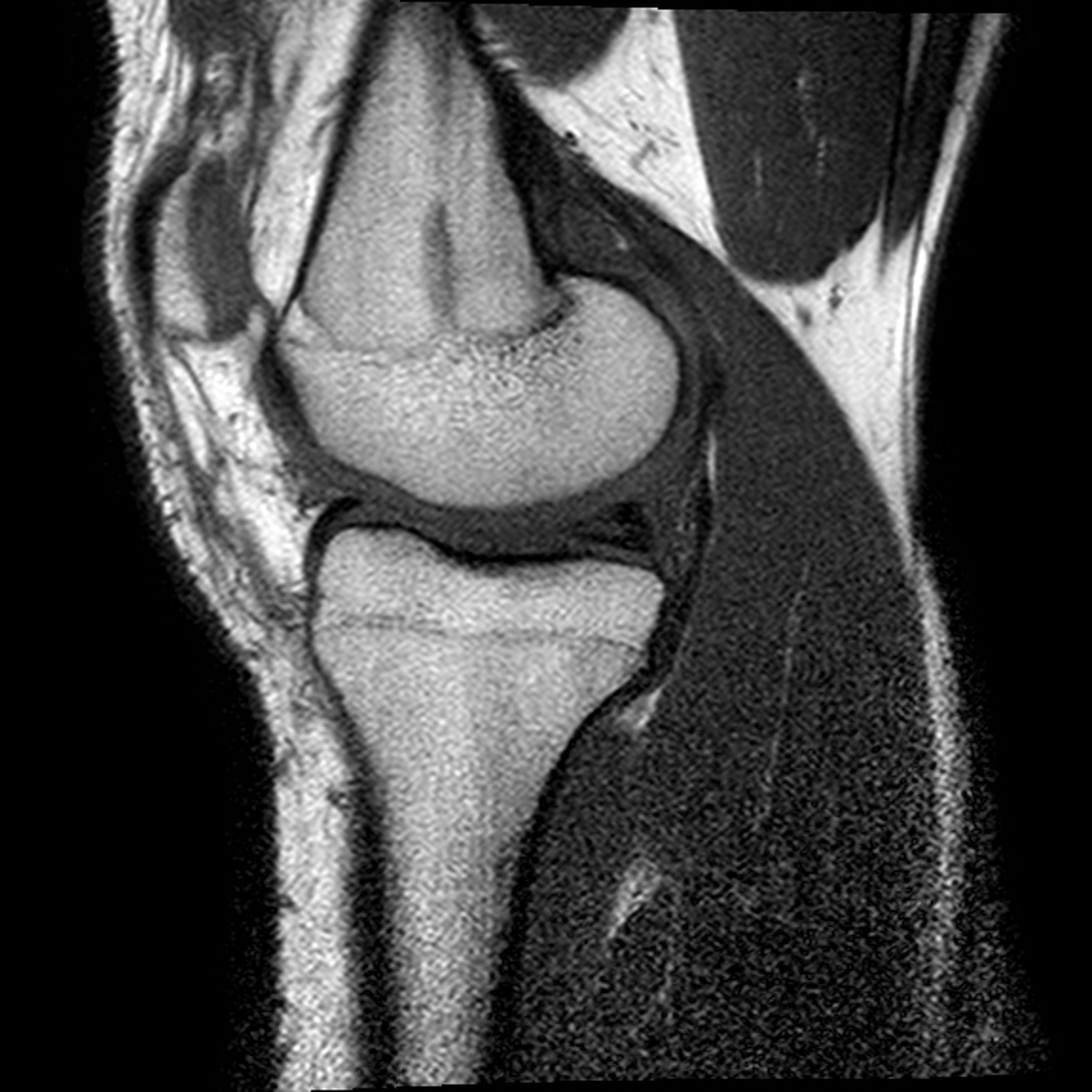 后叉韧带断裂临床表现