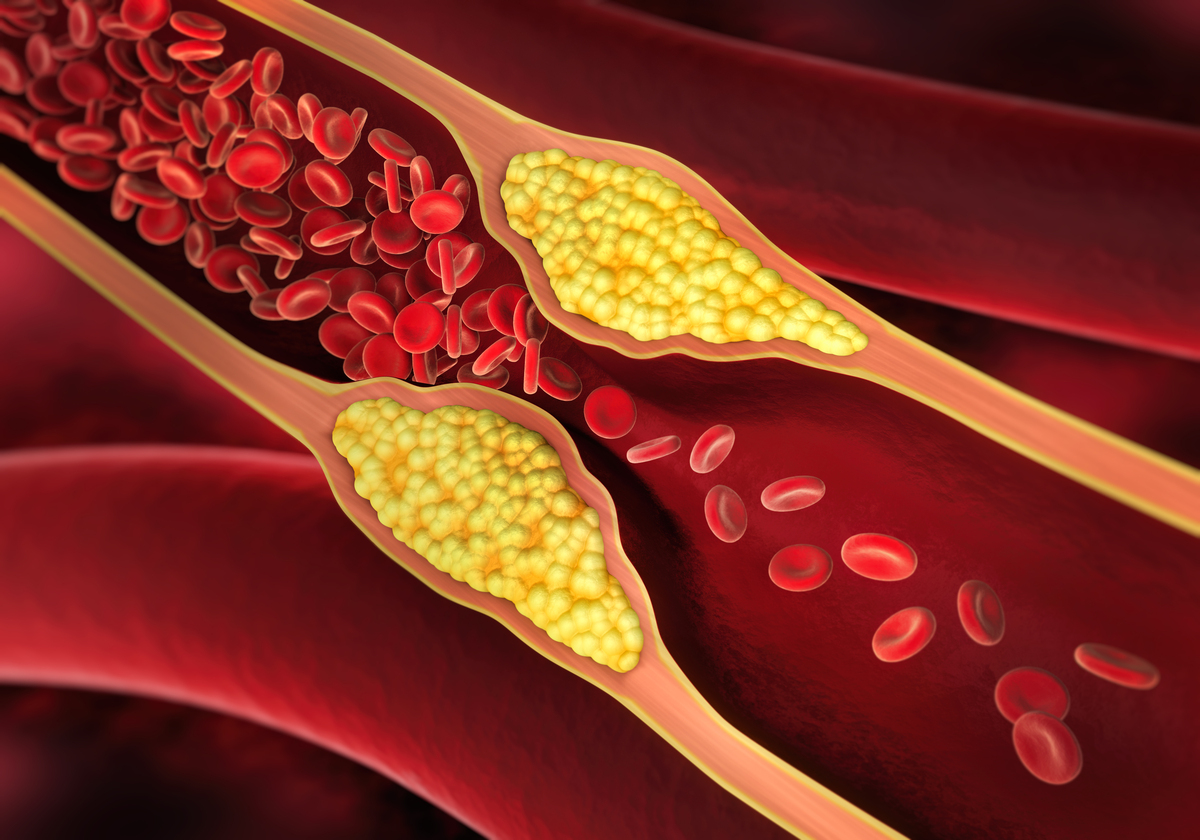 颈动脉斑块破裂致卒中：新生血管、血栓和溃疡的连锁反应
