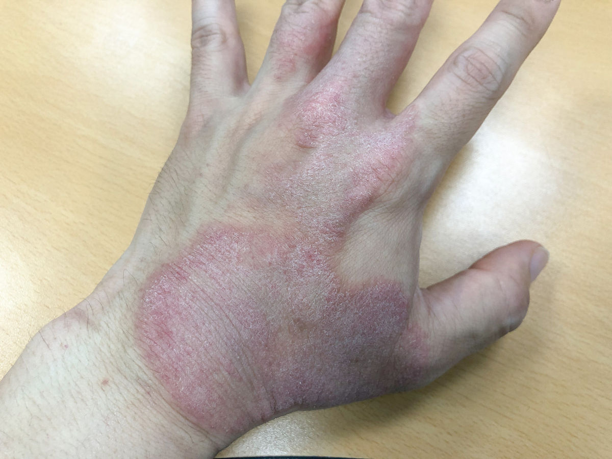 为什么人会抓痒？抓痒的原因及危害