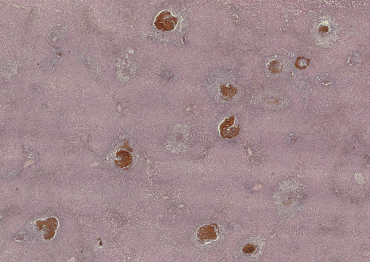 溶血引起的黄疸属于哪种类型的黄疸？属于肝前性肝后性还是肝性？