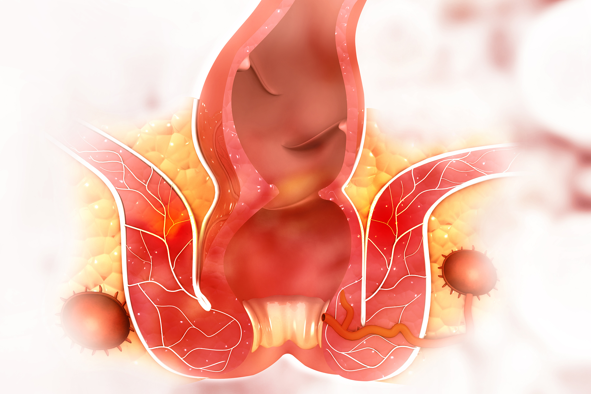 haemorrhoids (piles) on scientific background