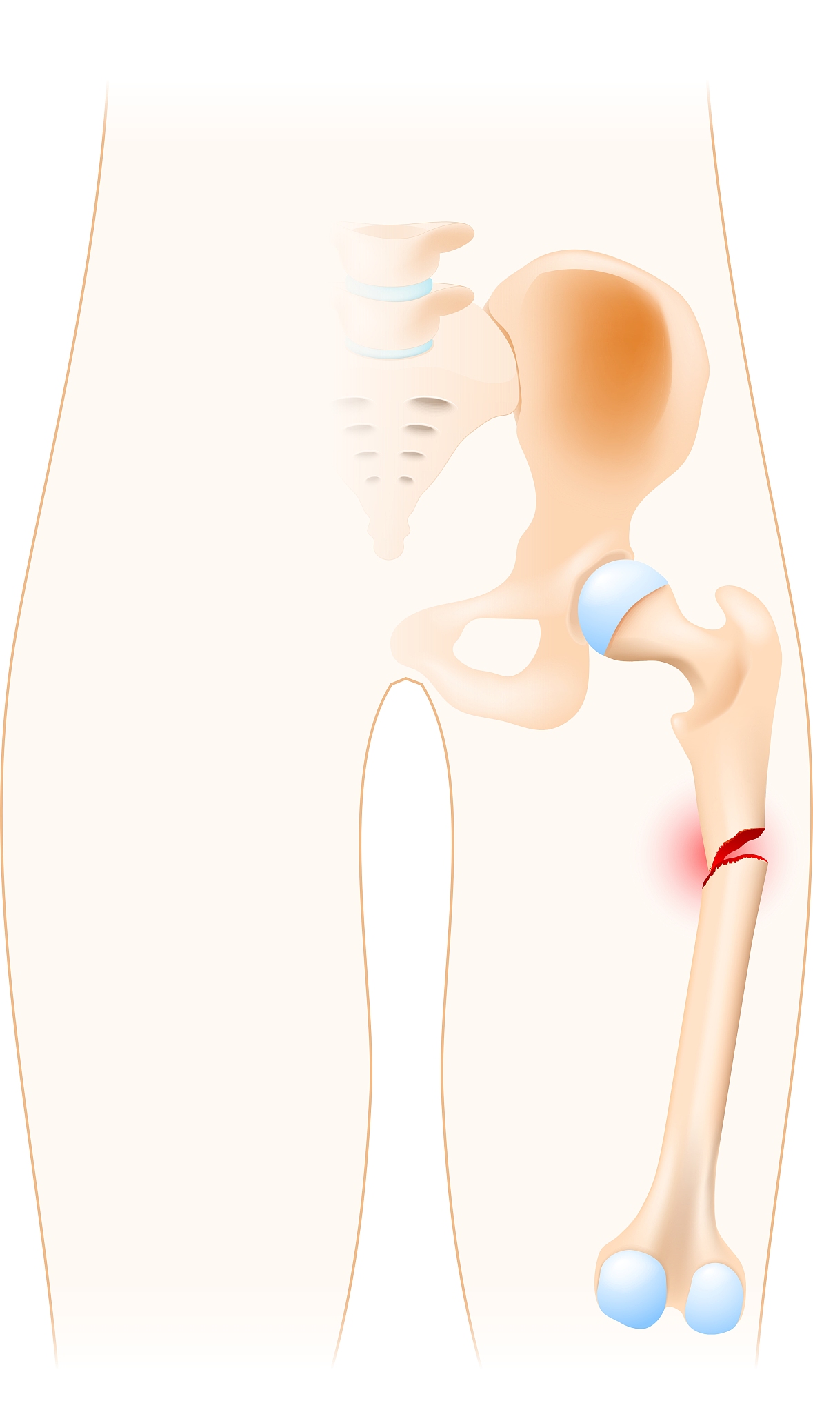 老年股骨粗隆间骨折术后护理：体征监测、并发症预防及饮食方案