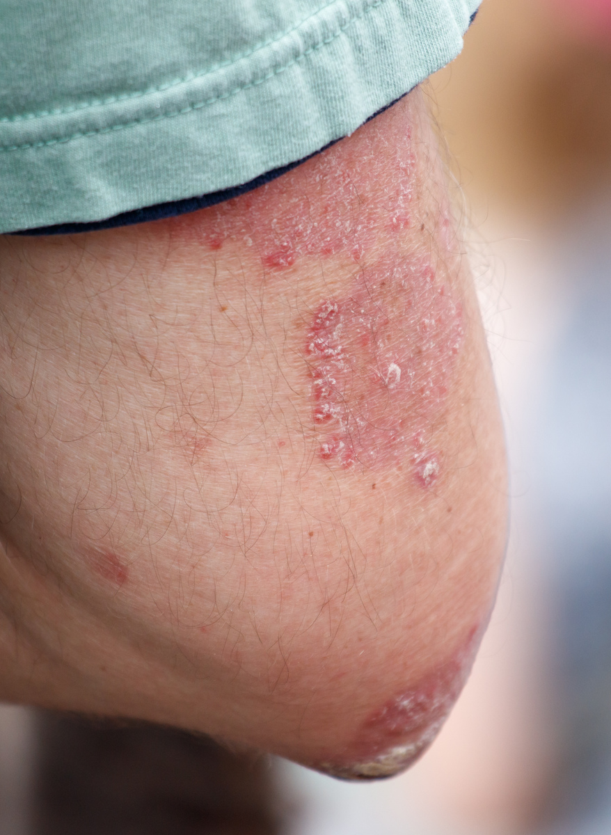 长疹子的原因：遗传、皮肤、环境、饮食等因素