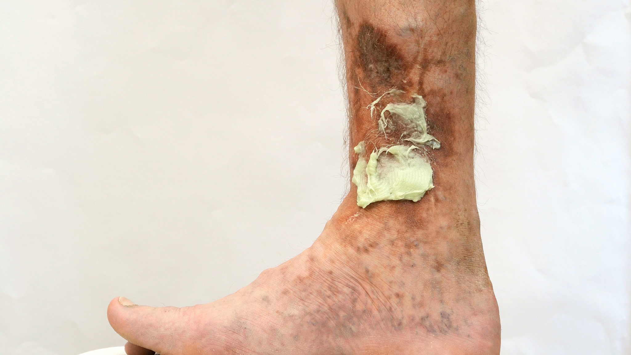 被铁锈擦破皮渗了点血