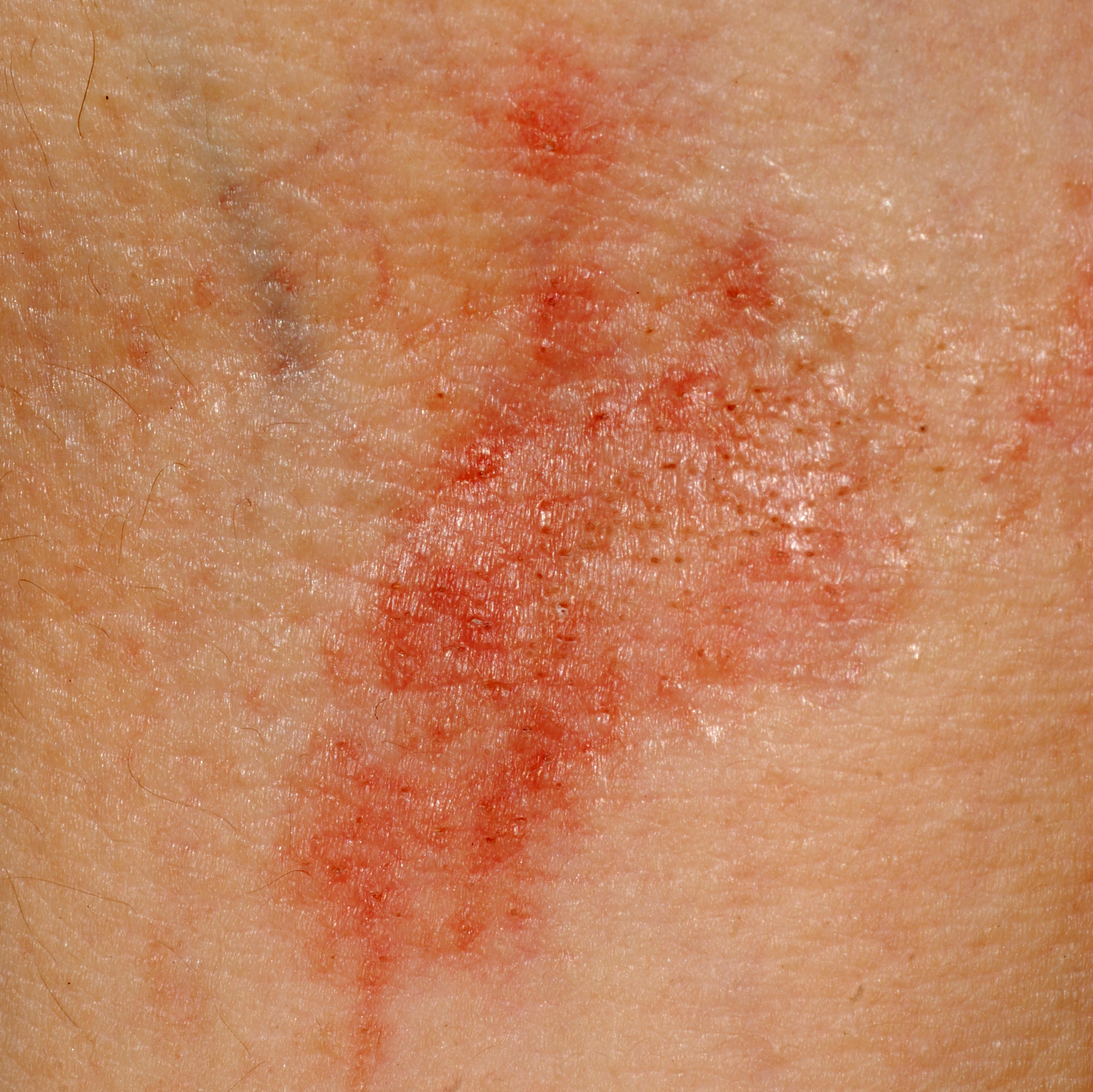 孩子对大米、小麦、牛奶、大豆、鸡蛋过敏？如何安排食谱？