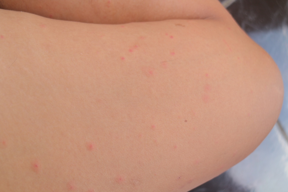 坐在地上屁股会出疹子吗？原因和预防