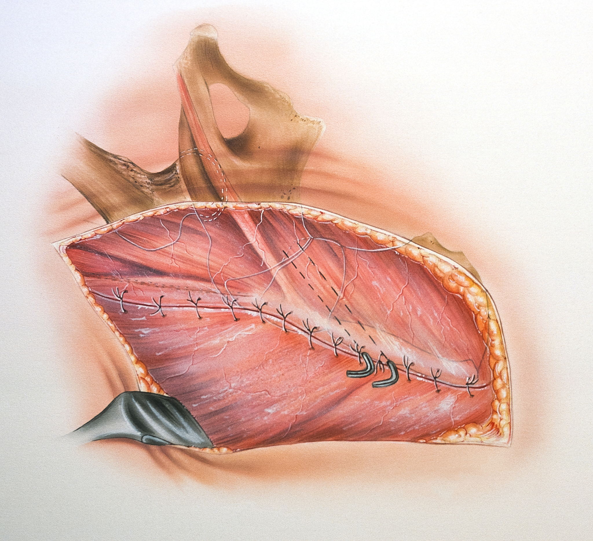 腹壁切口愈合的关键：肌肉层愈合