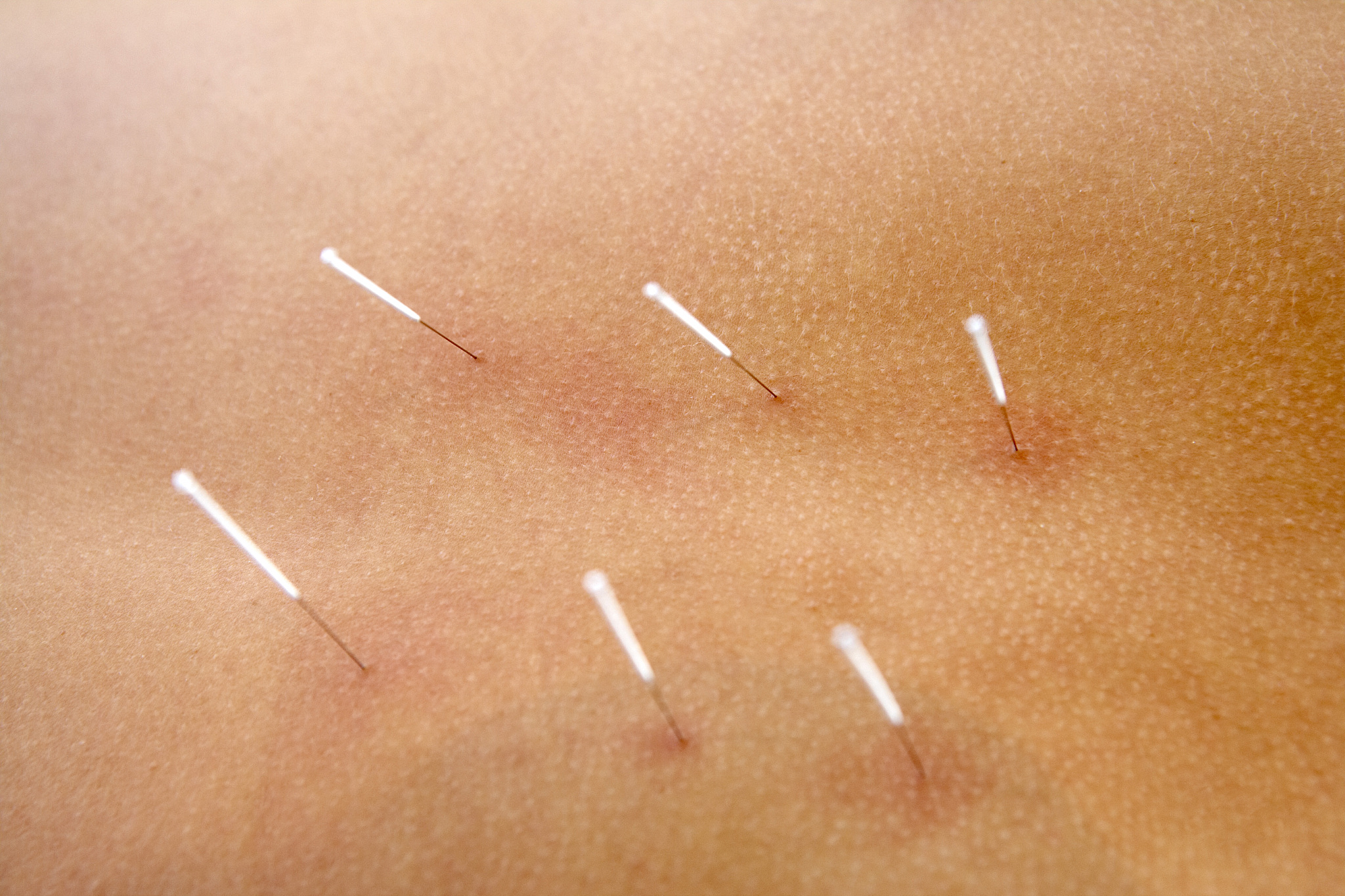 acupuncture needles on person's back