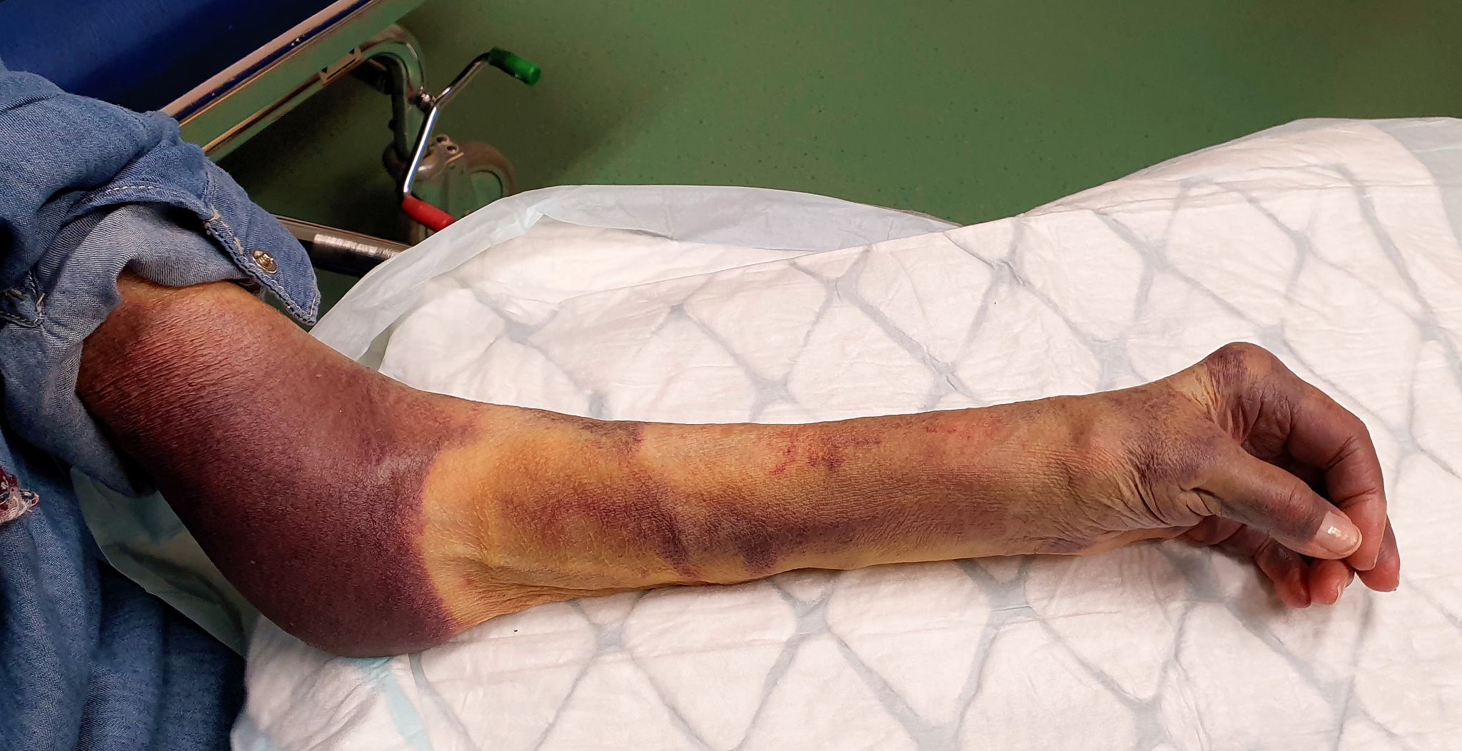 外科学判断题:夏天不慎开水烫伤右下肢浅二度烧伤清创后采用包扎疗法创面凃甲紫后包扎 外科学判断题:夏天不慎开水烫伤右下肢浅二度烧伤清创后采用包扎疗法创面凃甲紫后包扎