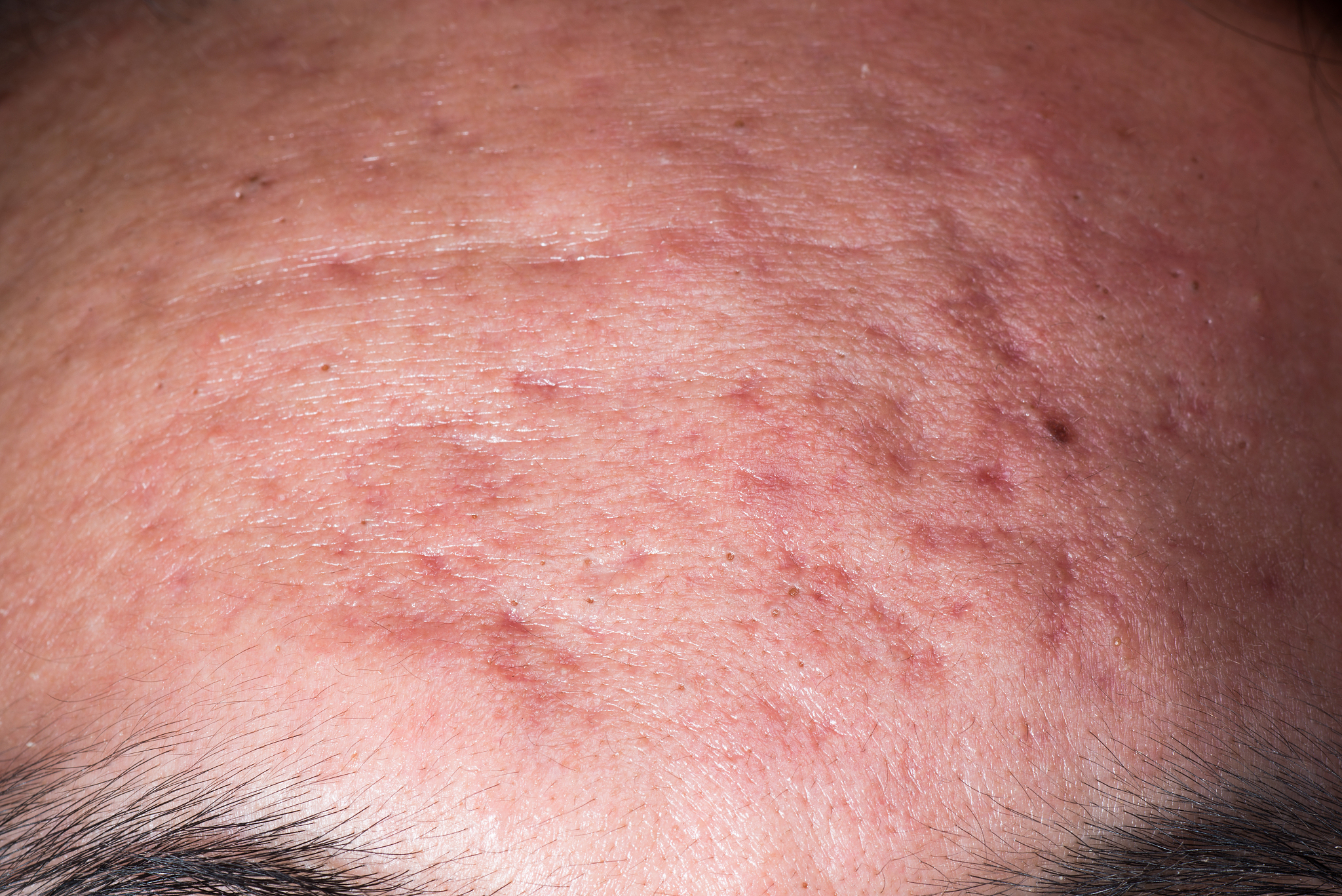 ill skin disease, whelk pimple on face.