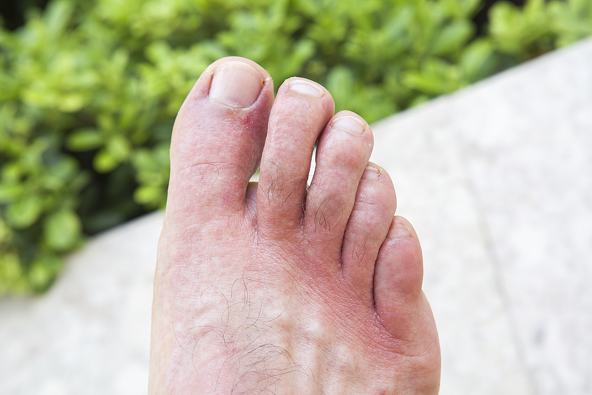 脚气怎么治疗？