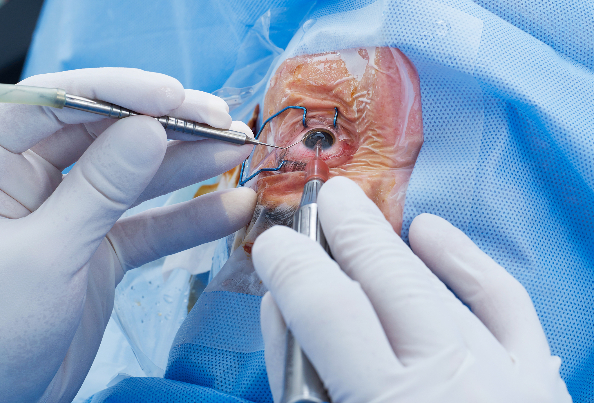 eye surgery close-up