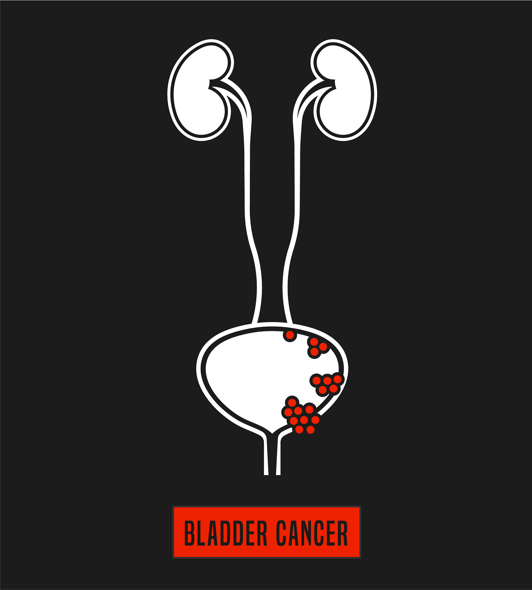 膀胱癌尿路造口并发症护理