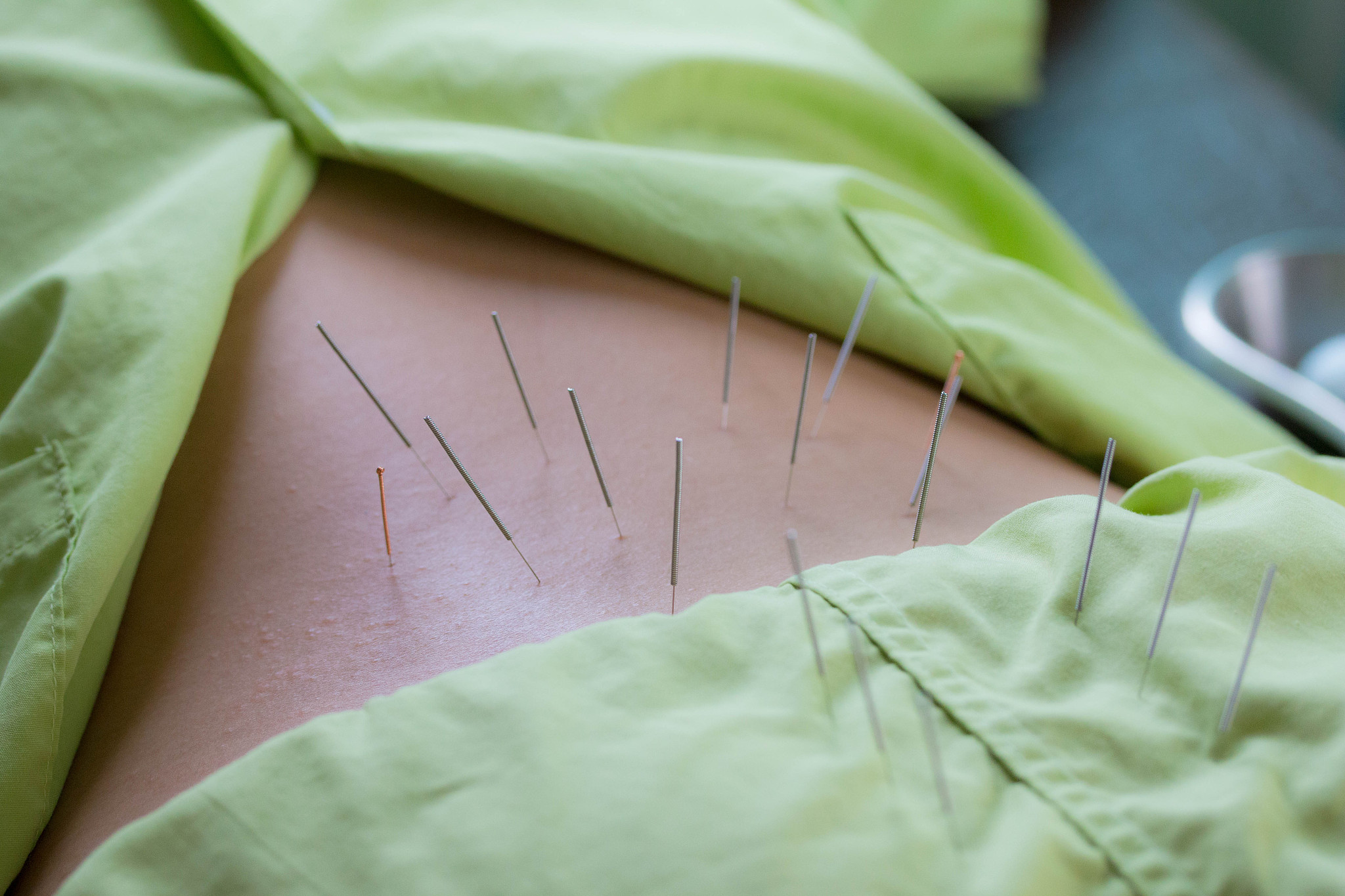 cropped image of woman with acupuncture needles